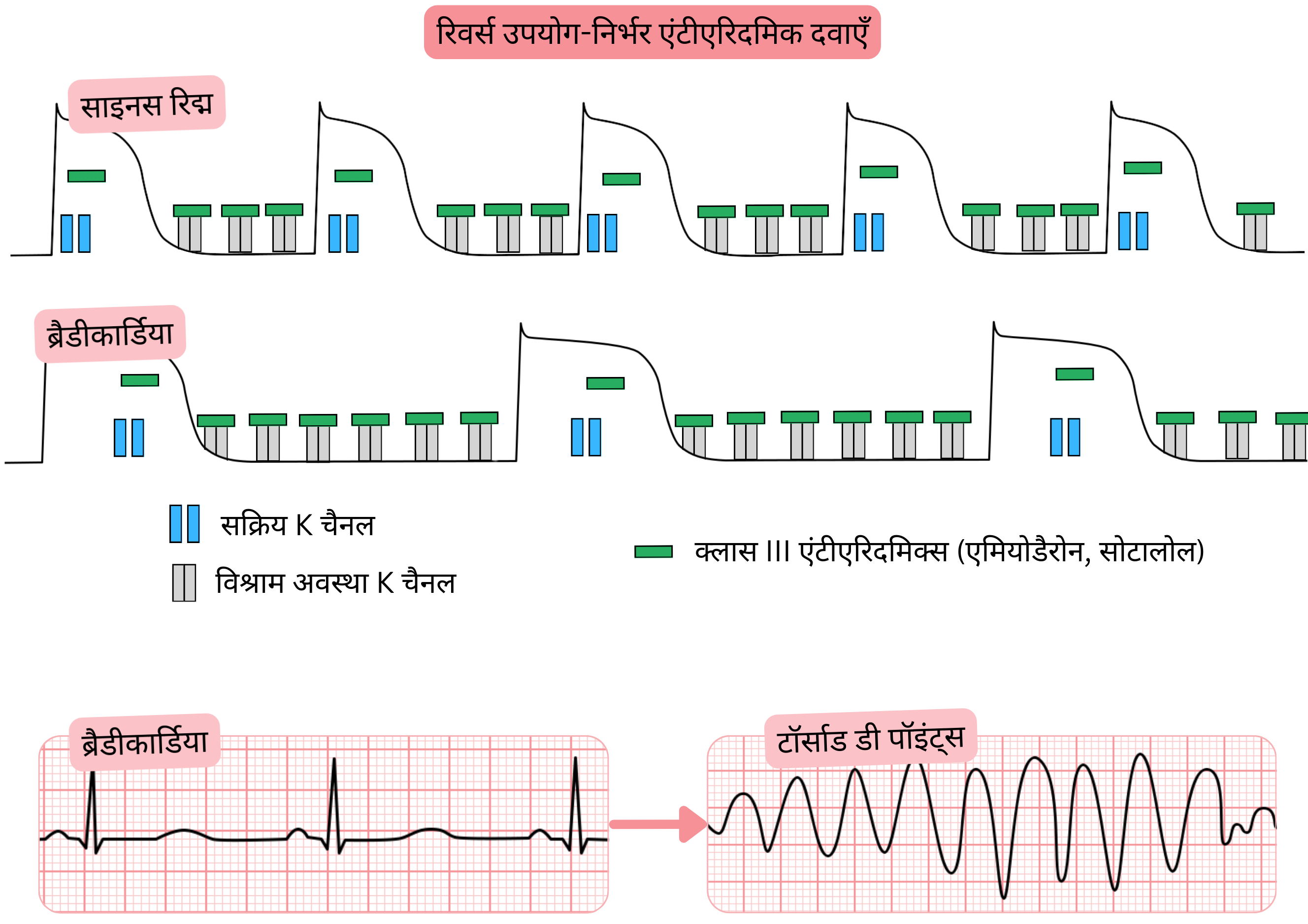 क्लास III एंटीएरिदमिक दवाओं की रिवर्स यूज़-डिपेंडेंस का आरेख, जिसमें ब्रैडीकार्डिया के दौरान पोटैशियम चैनल ब्लॉकेड अधिक स्पष्ट होता है, जिससे एक्शन पोटेंशियल और QT अंतराल बढ़ते हैं तथा torsades de pointes का जोखिम बढ़ता है।