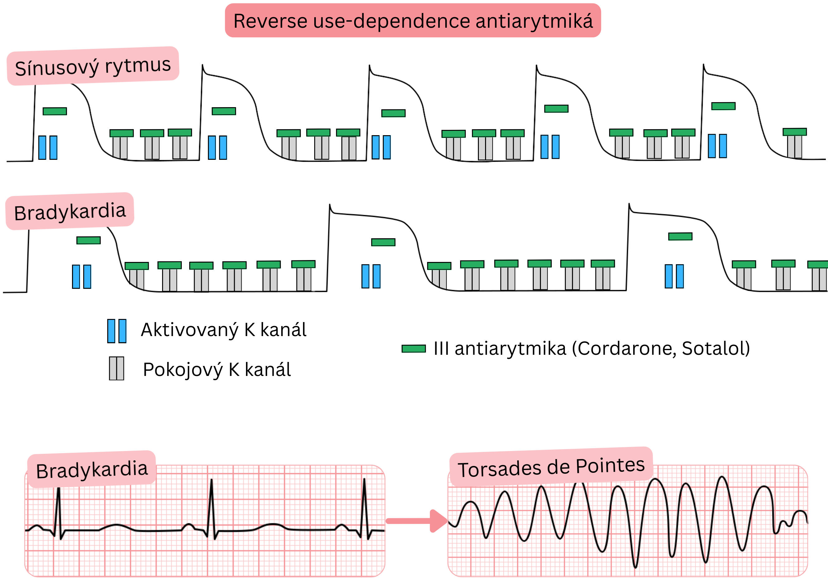 Schéma reverznej use-dependencie antiarytmík triedy III znázorňujúca výraznejšiu blokádu draslíkových kanálov pri bradykardii s predĺžením akčného potenciálu, QT intervalu a zvýšeným rizikom torsades de pointes.