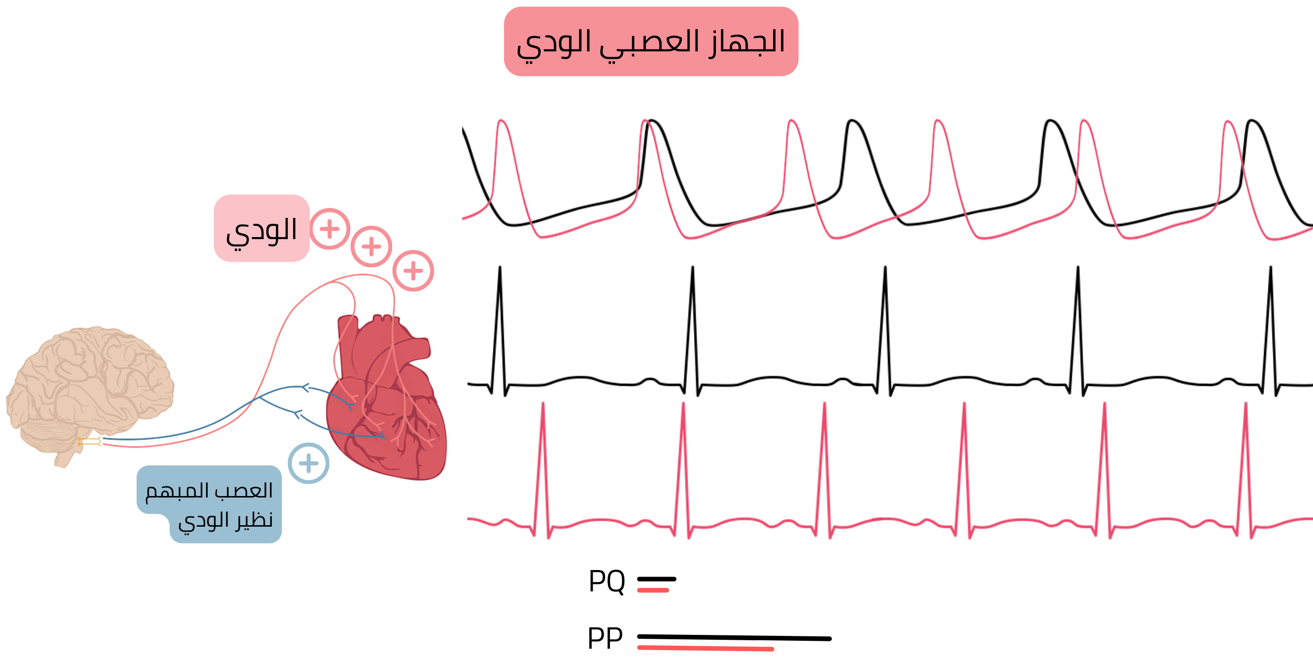 مخطط سيادة الجهاز العصبي الودي يوضح زيادة نشاط الجهاز العصبي الودي مع تسارع النظم الجيبي وقِصر فترتي PP وPQ على تخطيط القلب.