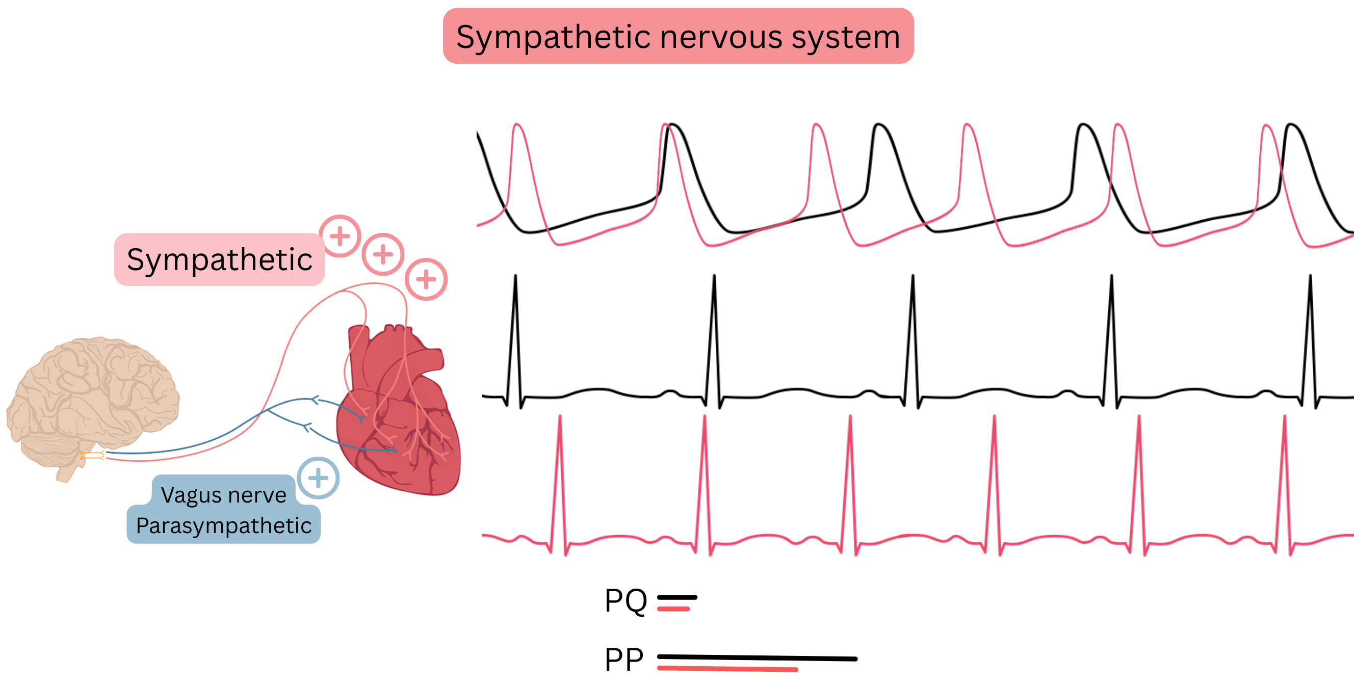 Diagram of sympathetic dominance illustrating increased sympathetic nervous system activity with acceleration of sinus rhythm and shortening of the PP and PQ intervals on ECG.