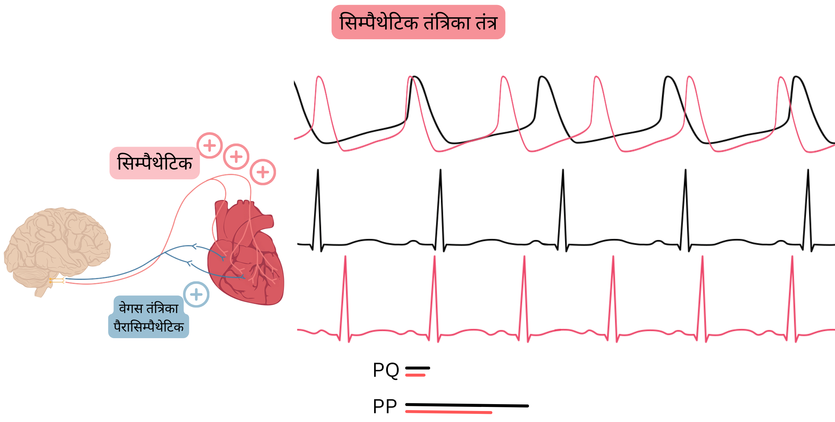 सिम्पैथेटिक प्रभुत्व का आरेख, जिसमें सिम्पैथेटिक नर्वस सिस्टम की बढ़ी हुई सक्रियता के कारण साइनस रिद्म में तेजी और ईसीजी पर PP तथा PQ अंतराल के संक्षेपण को दर्शाया गया है।