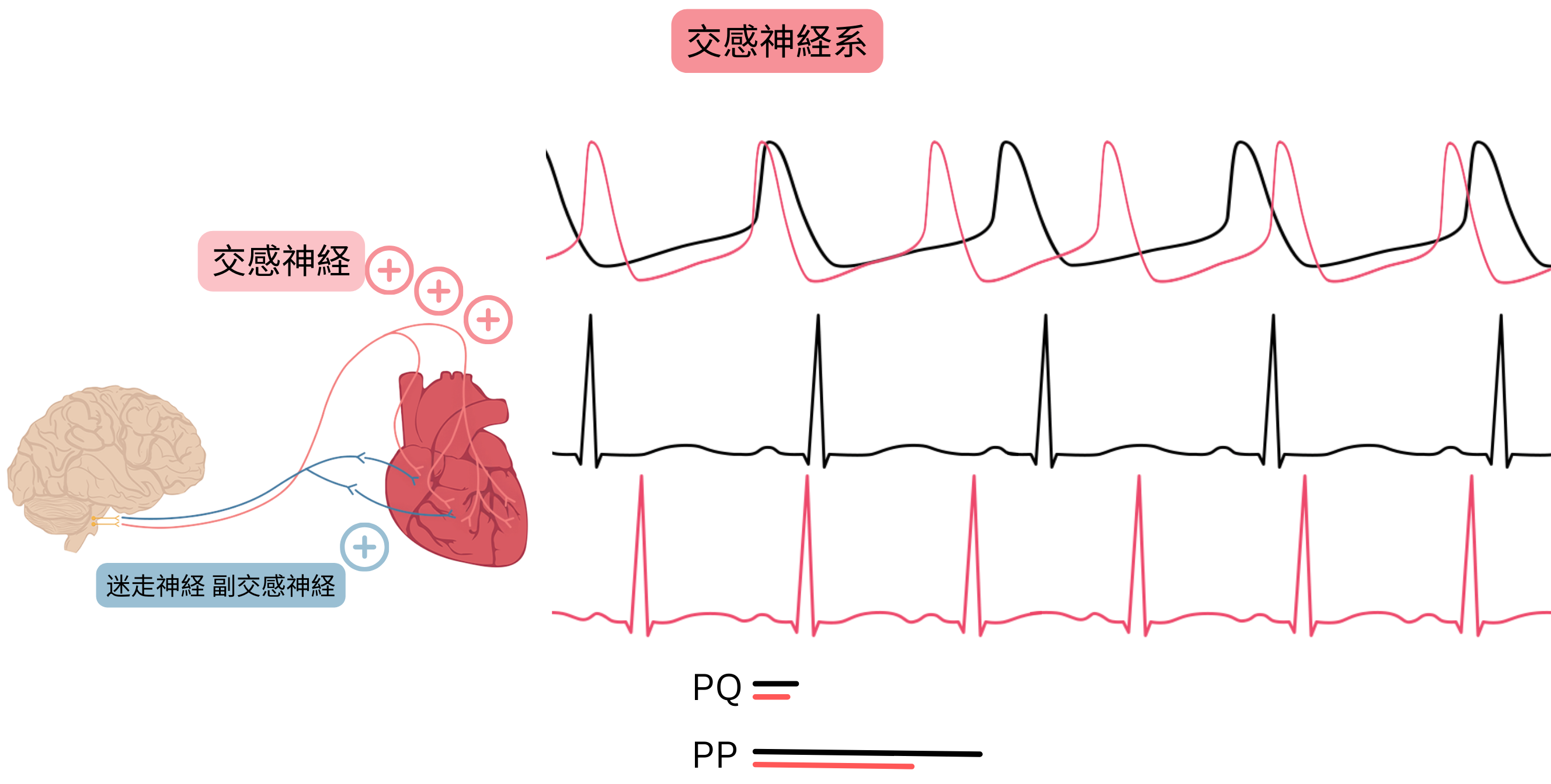交感神経優位を示す模式図で、交感神経系活動の亢進により洞調律が加速し、心電図のPPおよびPQ間隔が短縮することを示す。