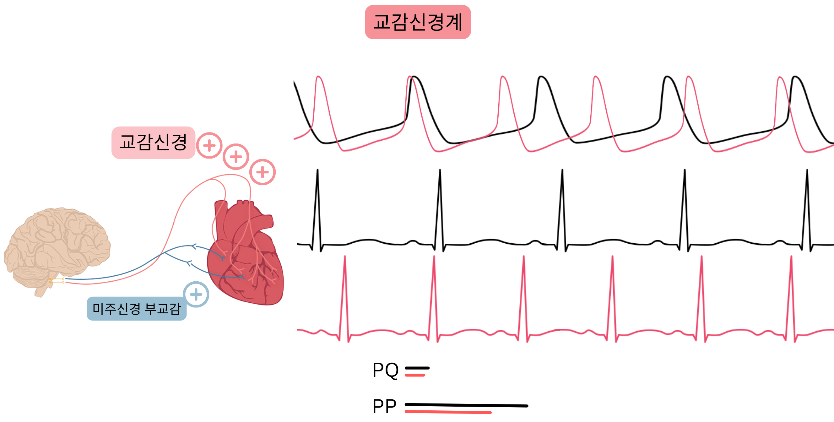 교감신경 우세를 나타낸 도식으로, 교감신경계 활성 증가로 동율동이 가속되고 심전도에서 PP 및 PQ 간격이 단축됨을 보여준다.