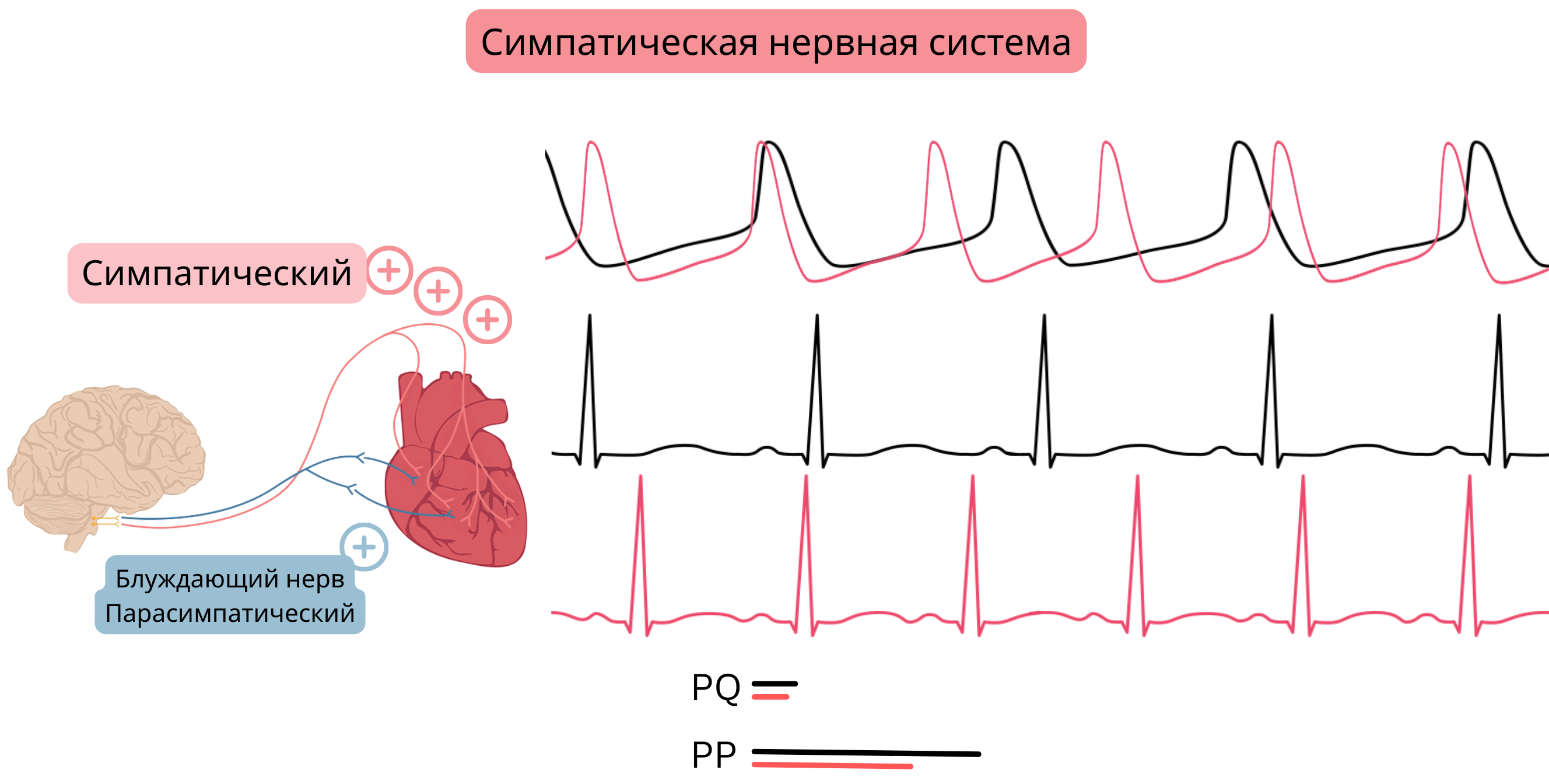 Схема доминирования симпатической нервной системы, демонстрирующая повышение её активности с учащением синусового ритма и укорочением интервалов PP и PQ на ЭКГ.