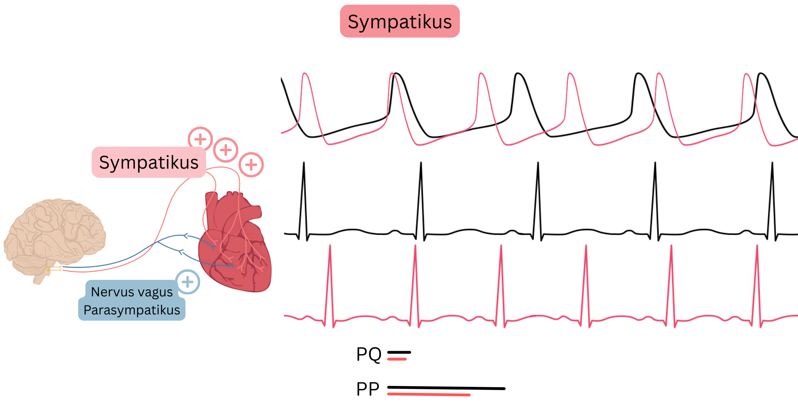 Schéma dominancie sympatika znázorňujúca zvýšenú aktivitu sympatického nervového systému s urýchlením sínusového rytmu a skrátením PP a PQ intervalu na EKG.