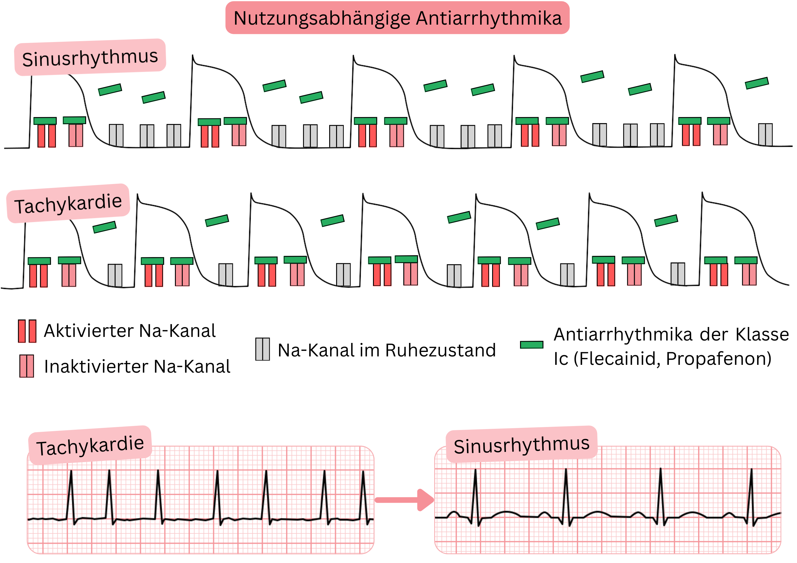 Schema der Use-Dependence von Antiarrhythmika der Klasse IC mit Darstellung der frequenzabhängigen Blockade von Natriumkanälen bei Tachykardie im Vergleich zum Sinusrhythmus unter Wirkung von Flecainid und Propafenon.