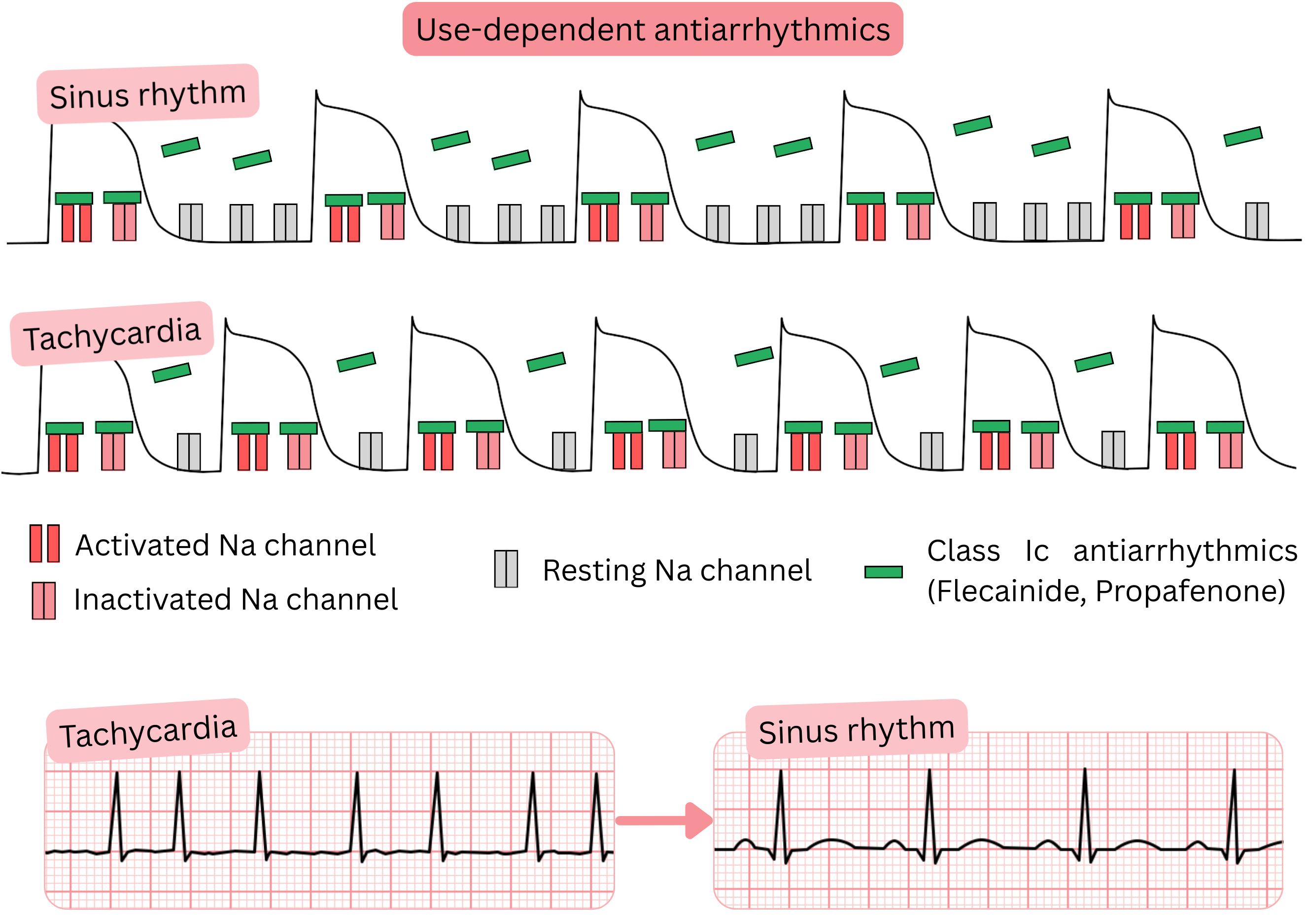Diagram of use dependence of class IC antiarrhythmic drugs illustrating frequency-dependent sodium channel blockade during tachycardia compared with sinus rhythm, highlighting the effects of flecainide and propafenone.