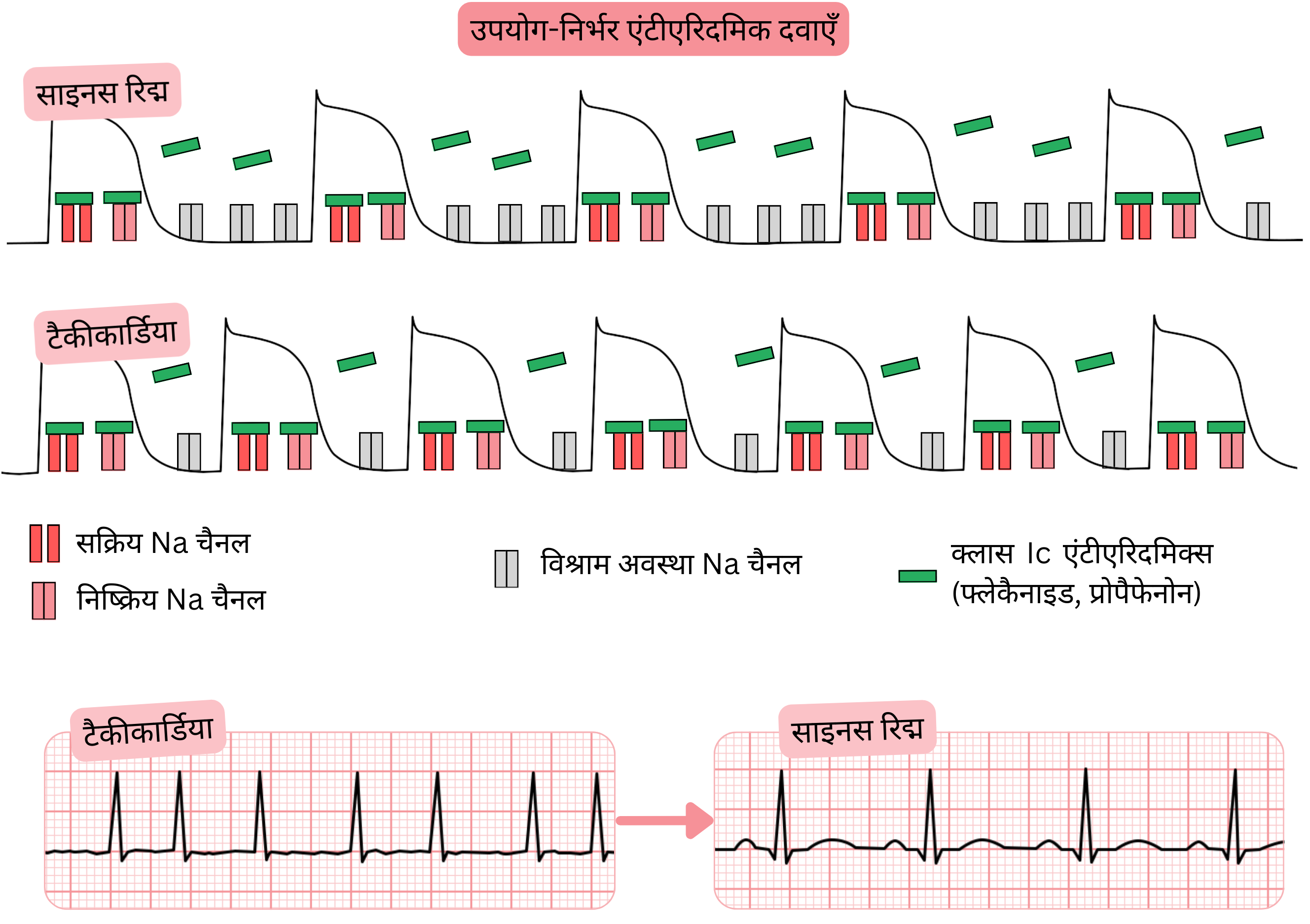 क्लास IC एंटीएरिदमिक दवाओं की यूज़-डिपेंडेंस का आरेख, जिसमें टैकीकार्डिया के दौरान साइनस रिद्म की तुलना में आवृत्ति-निर्भर सोडियम चैनल ब्लॉकेड तथा फ्लेकैनाइड और प्रोपैफेनोन का प्रभाव दर्शाया गया है।
