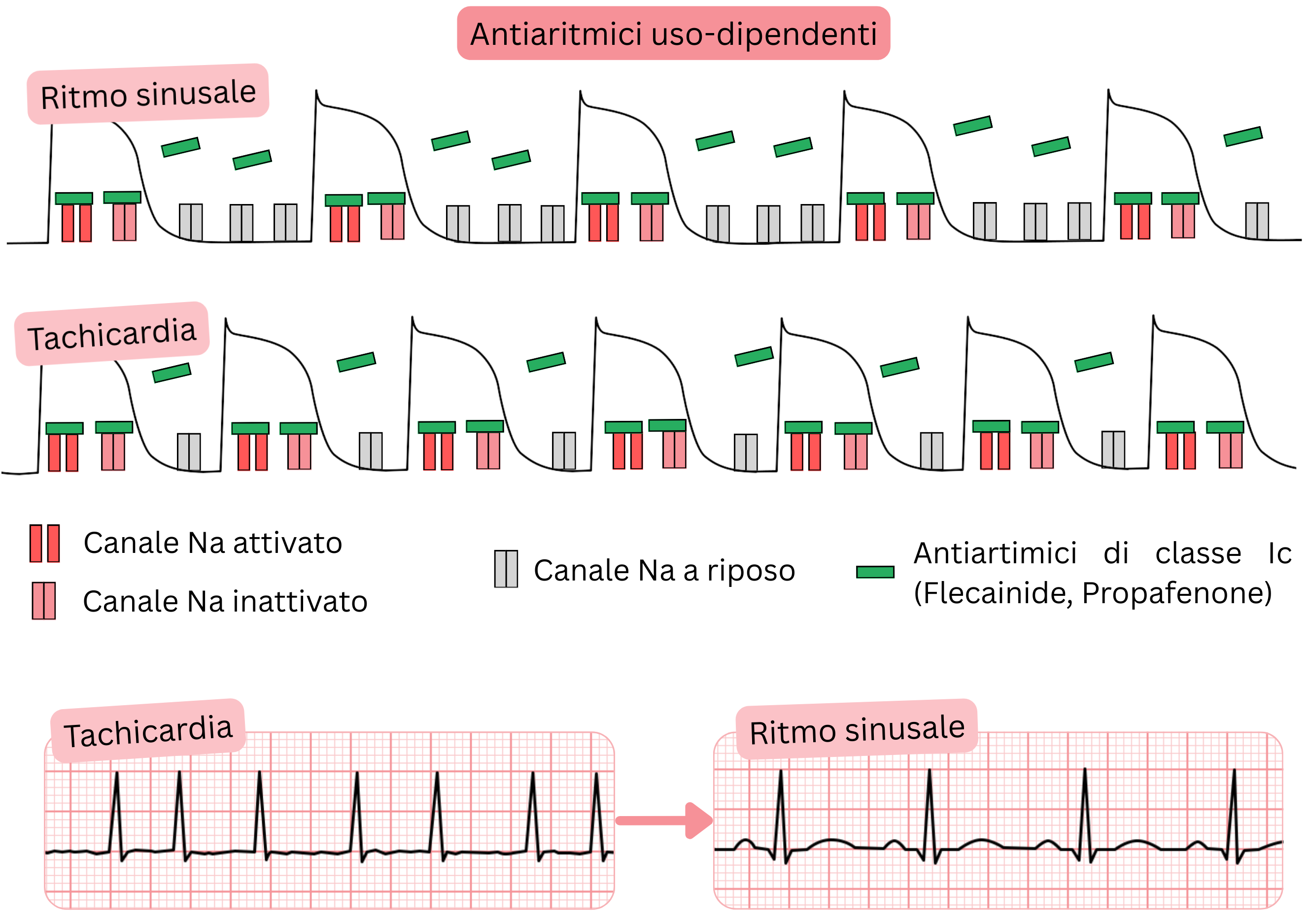 Schema della use-dependence degli antiaritmici di classe IC che illustra il blocco dei canali del sodio dipendente dalla frequenza durante la tachicardia rispetto al ritmo sinusale, con l’effetto di flecainide e propafenone.