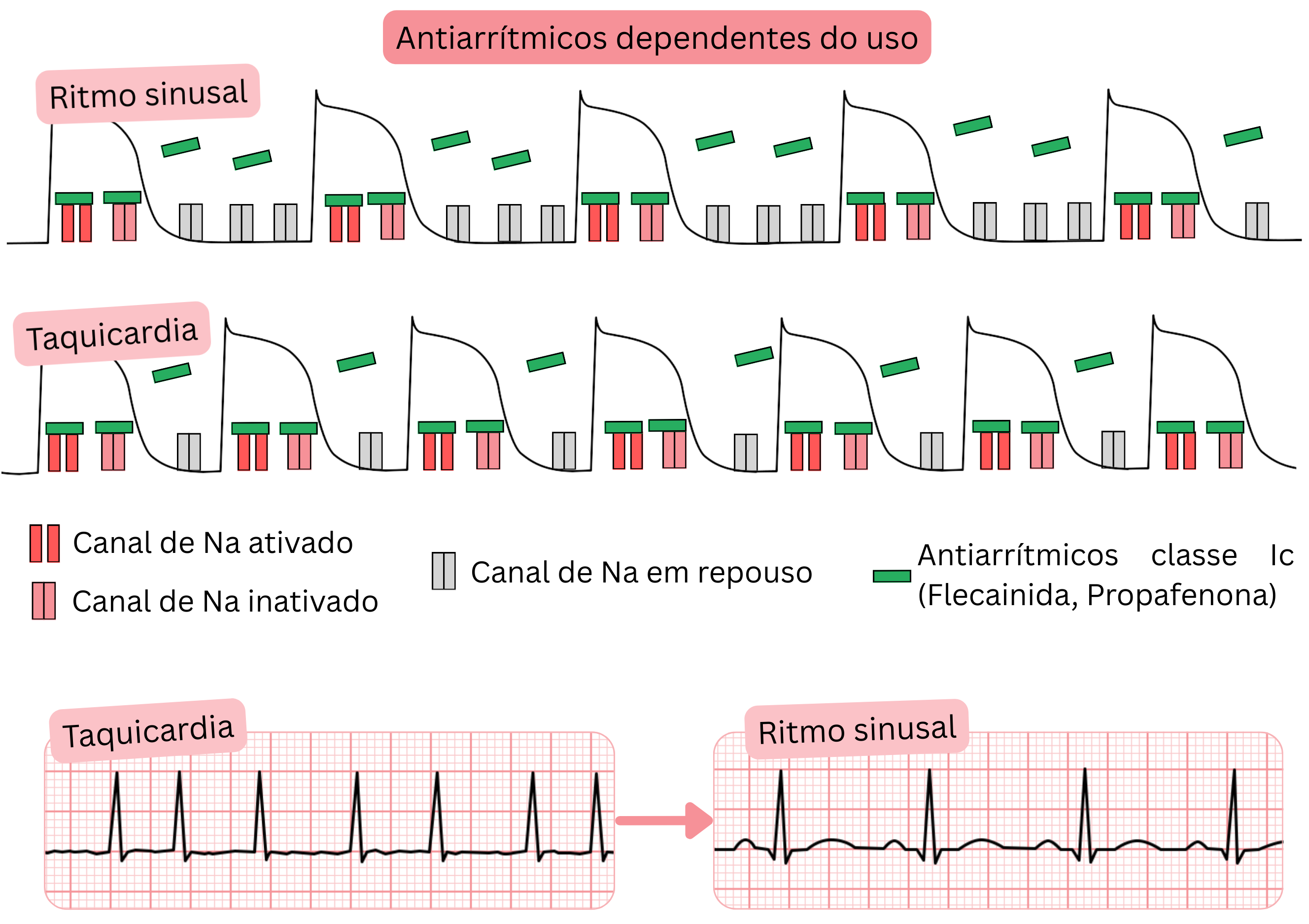 Esquema da dependência do uso dos antiarrítmicos de classe IC mostrando o bloqueio dos canais de sódio dependente da frequência durante a taquicardia em comparação com o ritmo sinusal, com o efeito da flecainida e da propafenona.