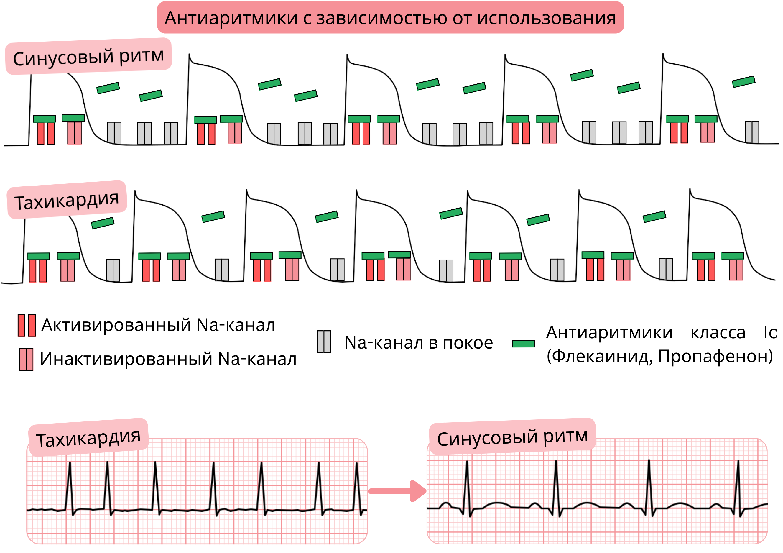 Схема зависимости от использования антиаритмических препаратов класса IC, демонстрирующая частотно-зависимую блокаду натриевых каналов при тахикардии по сравнению с синусовым ритмом с эффектом флекаинида и пропафенона.