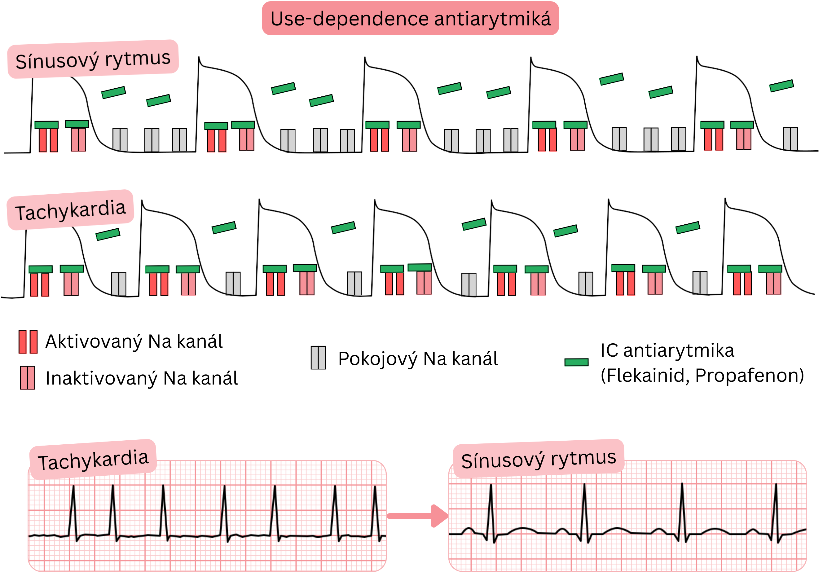 Schéma use-dependencie antiarytmík triedy IC znázorňujúca frekvenčne závislú blokádu sodíkových kanálov pri tachykardii v porovnaní so sínusovým rytmom s účinkom flekainidu a propafenónu.