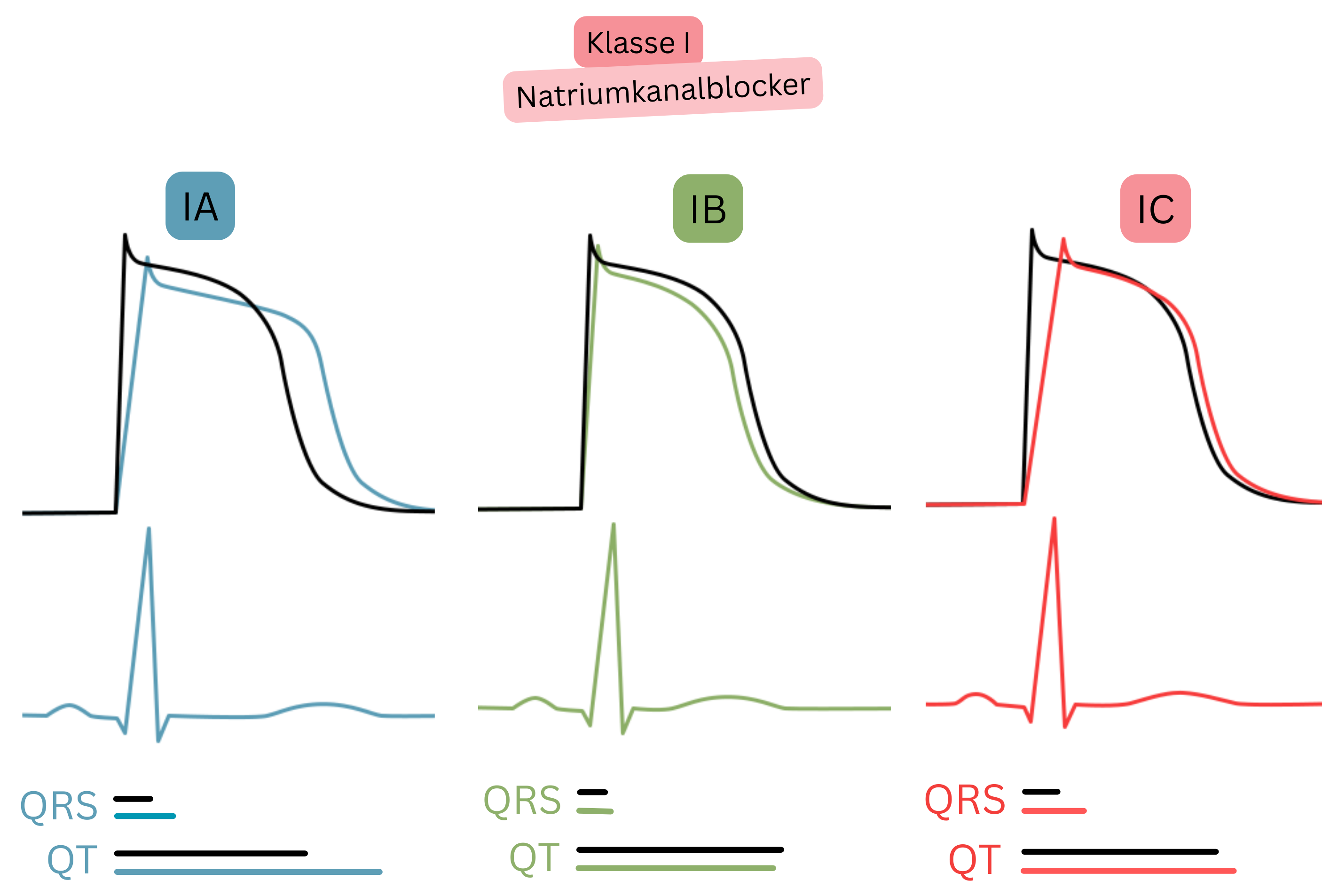 Schema der Wirkung von Antiarrhythmika der Klasse I mit Darstellung der Unterschiede zwischen den Unterklassen IA, IB und IC hinsichtlich des Effekts auf das Aktionspotenzial, die QRS-Komplexbreite und die QT-Intervall-Dauer im EKG.