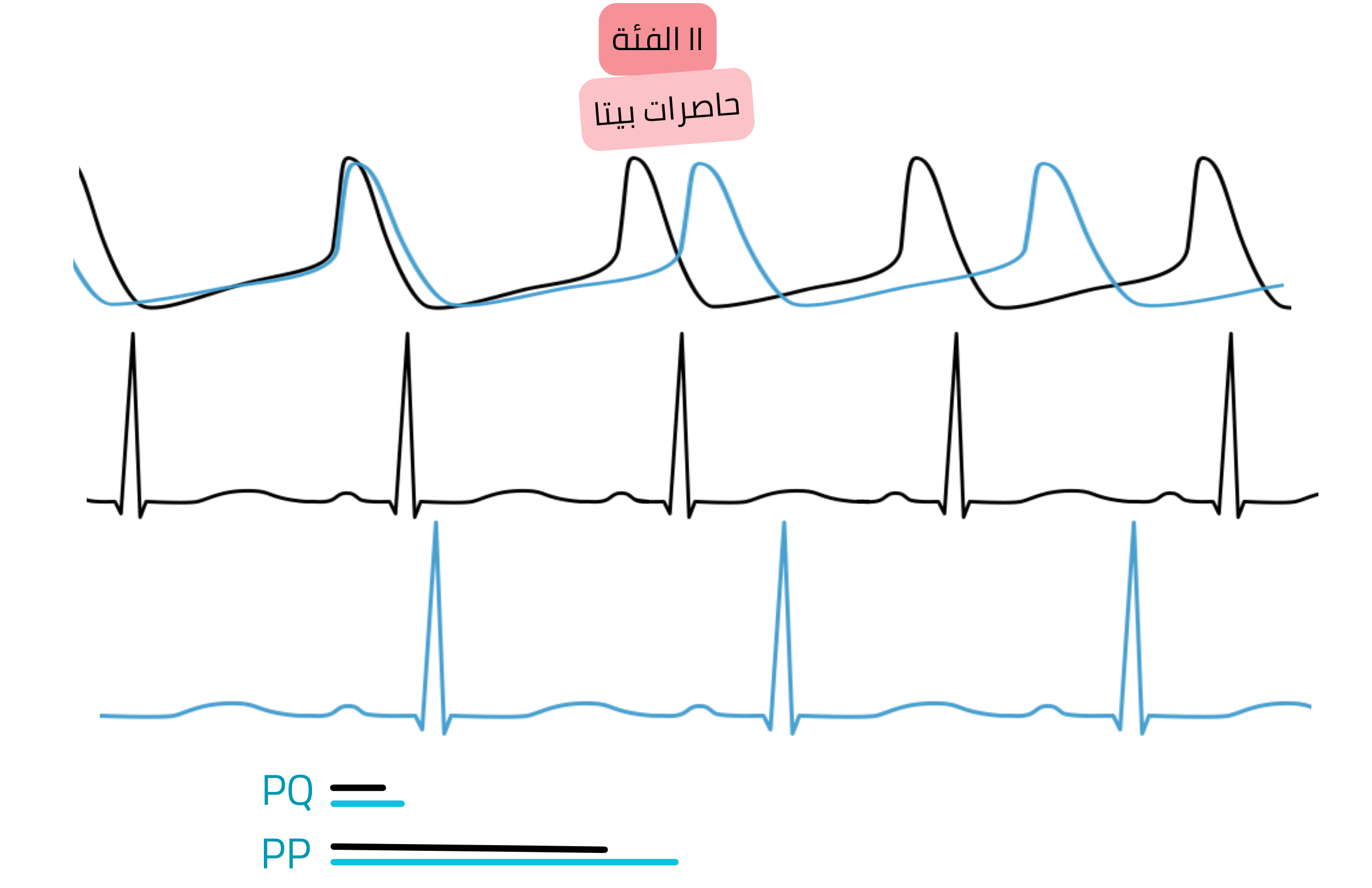 مخطط تأثير مضادات اضطراب النظم من الفئة II — حاصرات بيتا — يوضح تثبيط النشاط الودي مع تباطؤ النظم الجيبي وإطالة فترتي PP وPQ على تخطيط القلب.