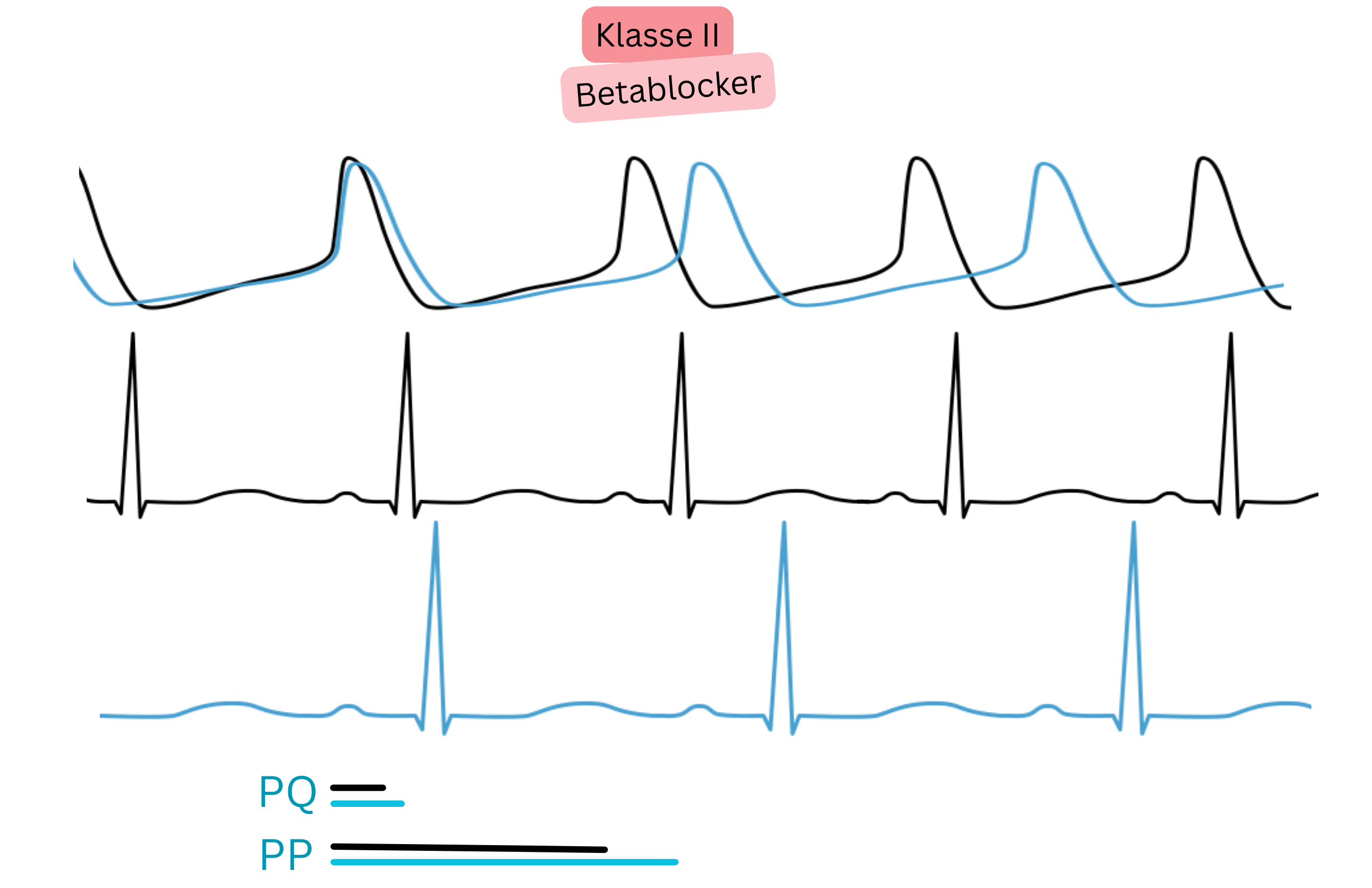 Schema der Wirkung von Antiarrhythmika der Klasse II — Betablockern — mit Darstellung der Hemmung der sympathischen Aktivität, Verlangsamung des Sinusrhythmus und Verlängerung der PP- und PQ-Intervalle im EKG.