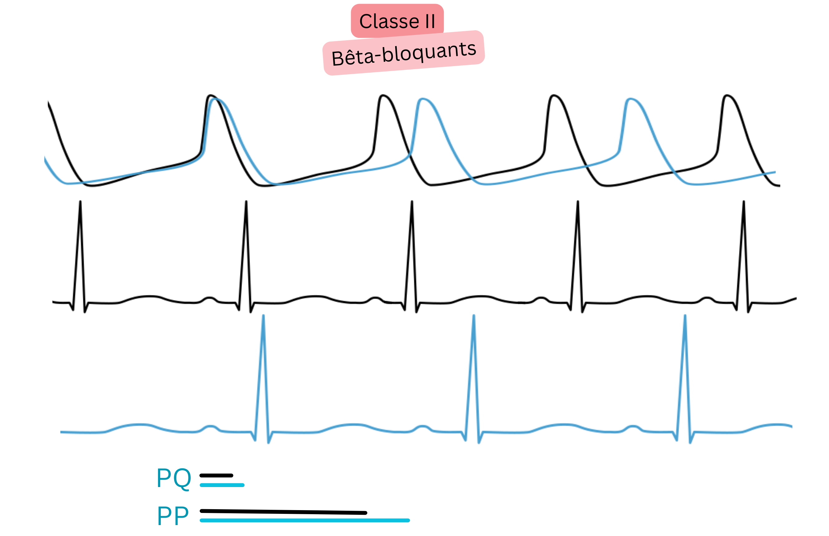 Schéma de l’effet des antiarythmiques de classe II — bêtabloquants — illustrant l’inhibition de l’activité sympathique avec ralentissement du rythme sinusal et allongement des intervalles PP et PQ à l’ECG.