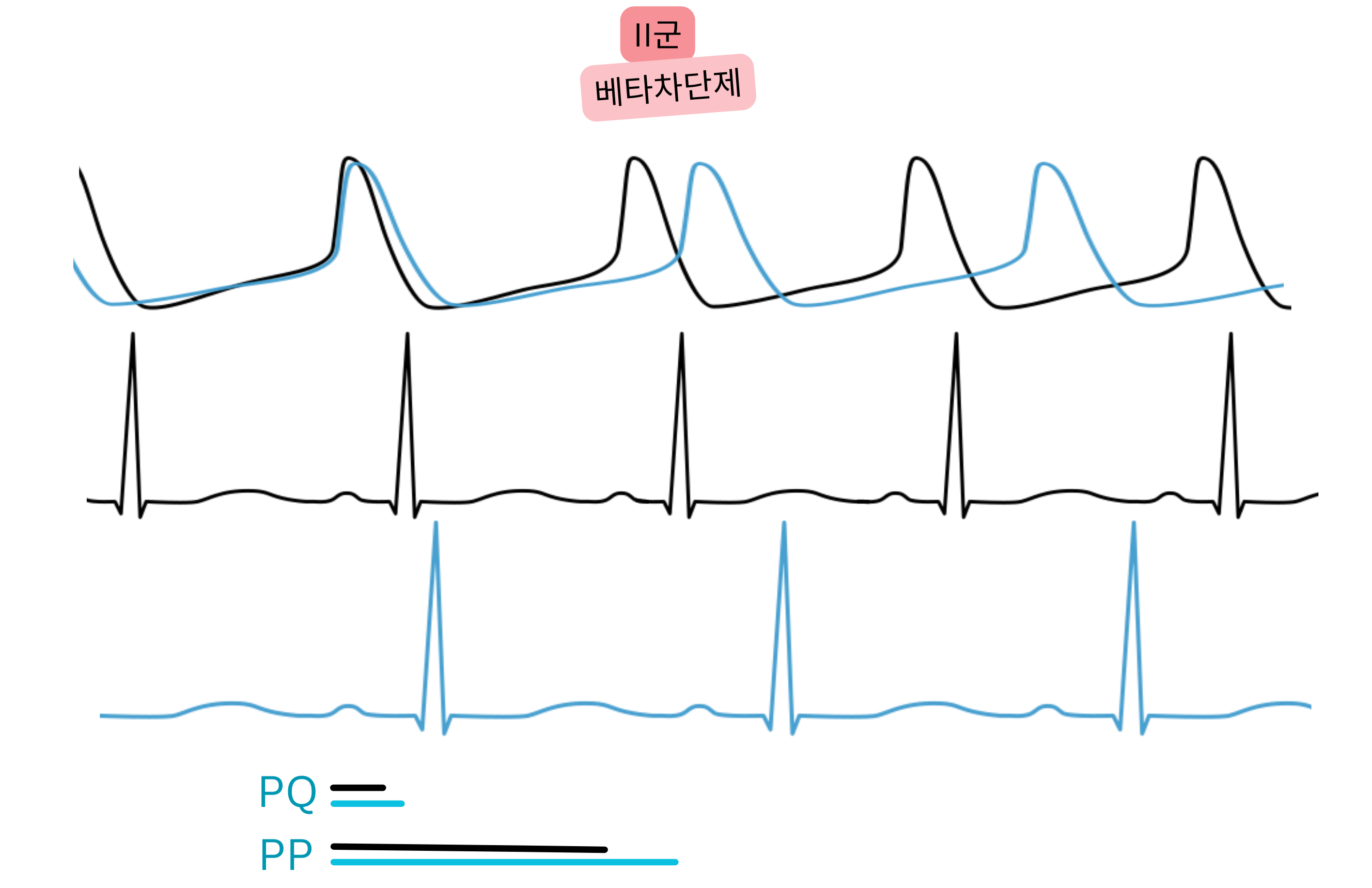 II군 항부정맥제인 베타차단제의 효과를 나타낸 도식으로, 교감신경 억제로 동율동이 느려지고 심전도에서 PP 및 PQ 간격이 연장됨을 보여준다.