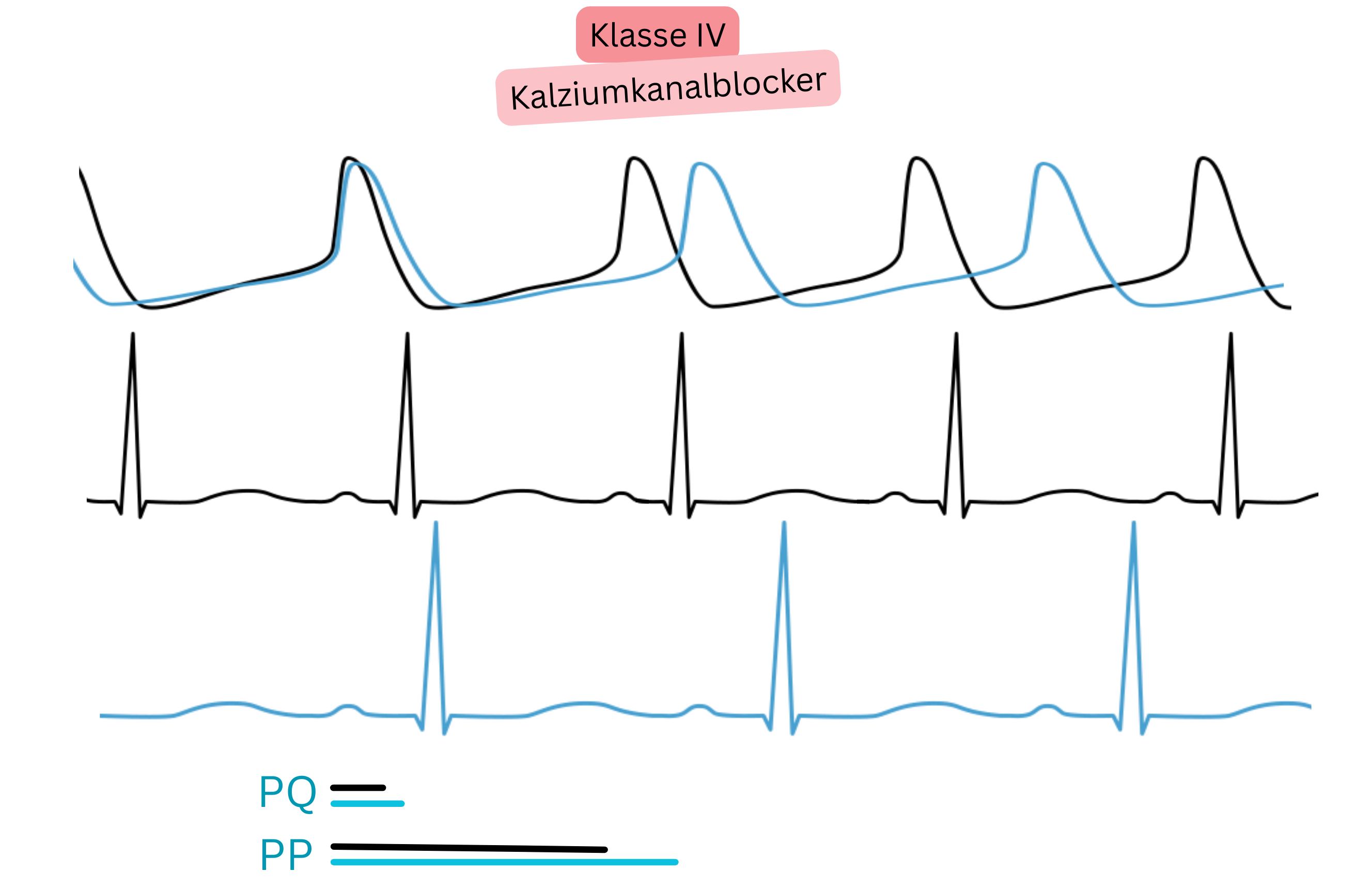 Schema der Wirkung von Antiarrhythmika der Klasse IV — Calciumkanalblockern — mit Darstellung einer Verlangsamung der AV-Überleitung, Verlängerung des PQ-Intervalls und Reduktion der Herzfrequenz im EKG.