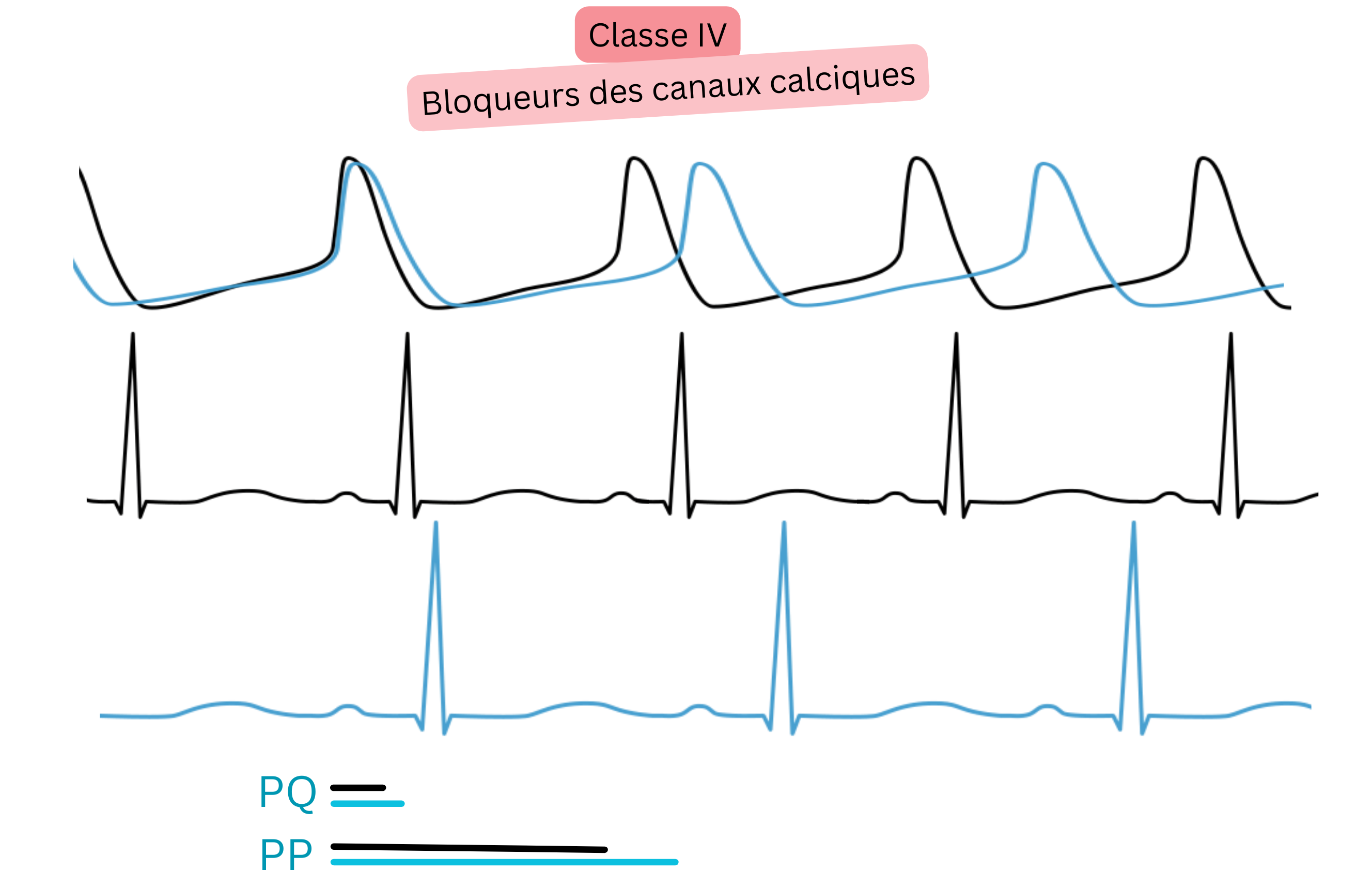 Schéma de l’effet des antiarythmiques de classe IV — inhibiteurs des canaux calciques — illustrant le ralentissement de la conduction auriculoventriculaire avec allongement de l’intervalle PQ et diminution de la fréquence cardiaque à l’ECG.