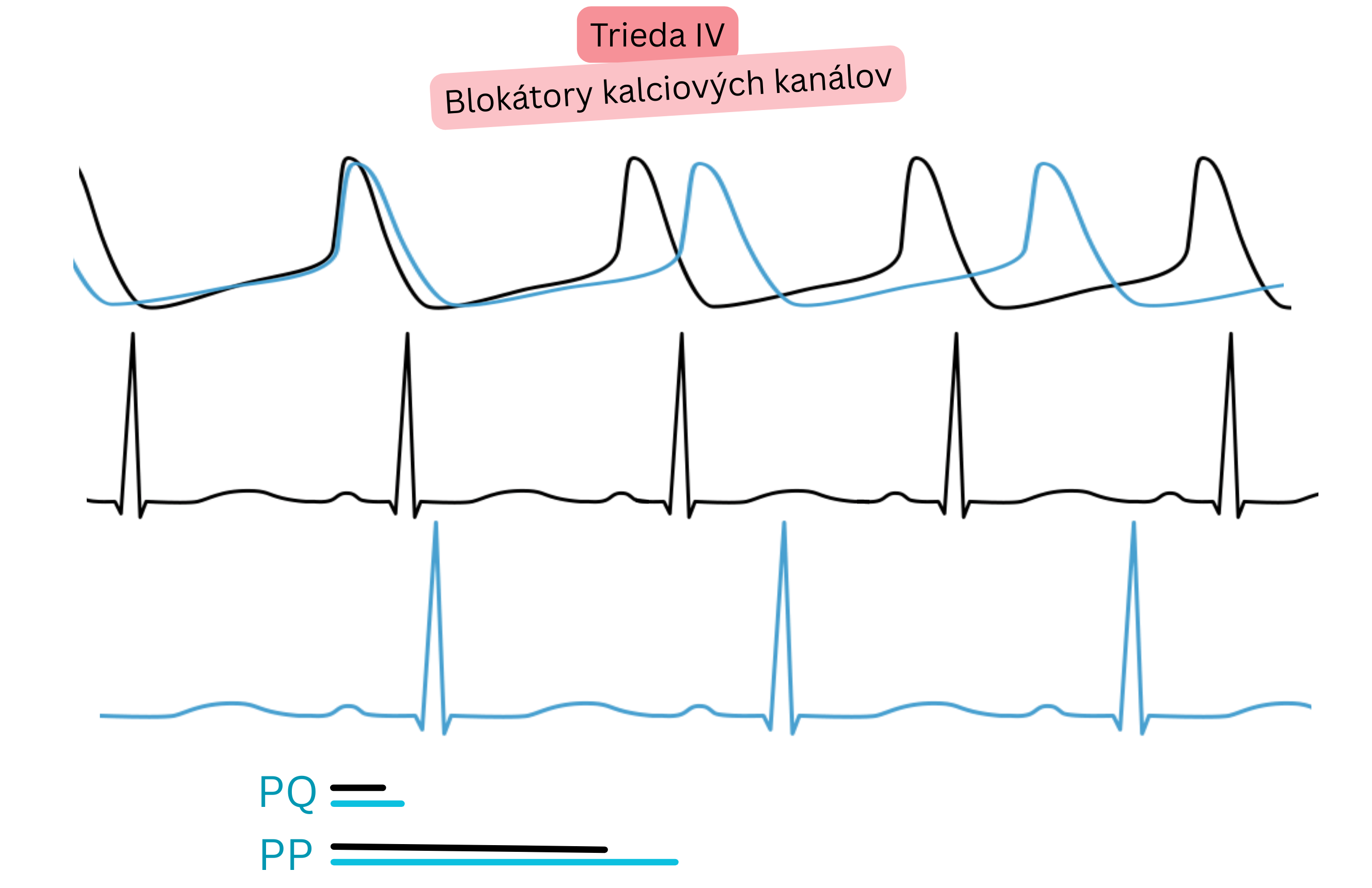 Schéma účinku antiarytmík triedy IV – blokátorov kalciových kanálov – znázorňujúca spomalenie AV vedenia s predĺžením PQ intervalu a znížením srdcovej frekvencie na EKG.