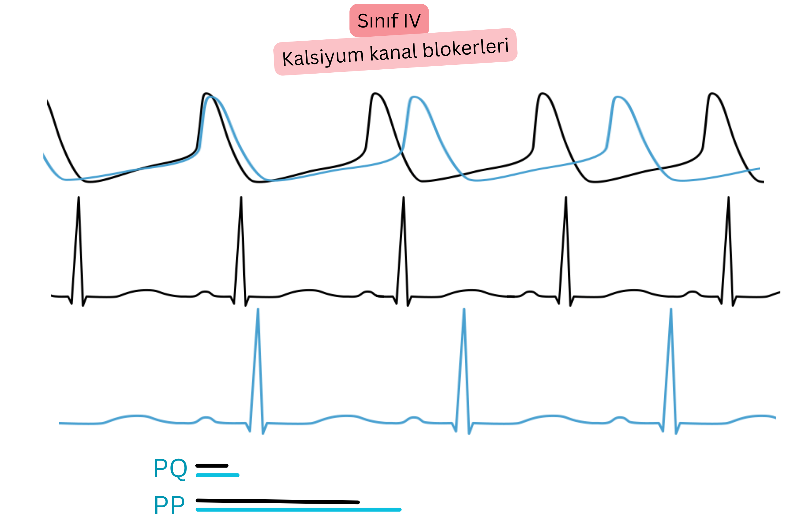 IV sınıfı antiaritmikler olan kalsiyum kanal blokerlerinin etkisini gösteren şema; AV iletimin yavaşlamasını, EKG’de PQ aralığının uzamasını ve kalp hızının azalmasını göstermektedir.
