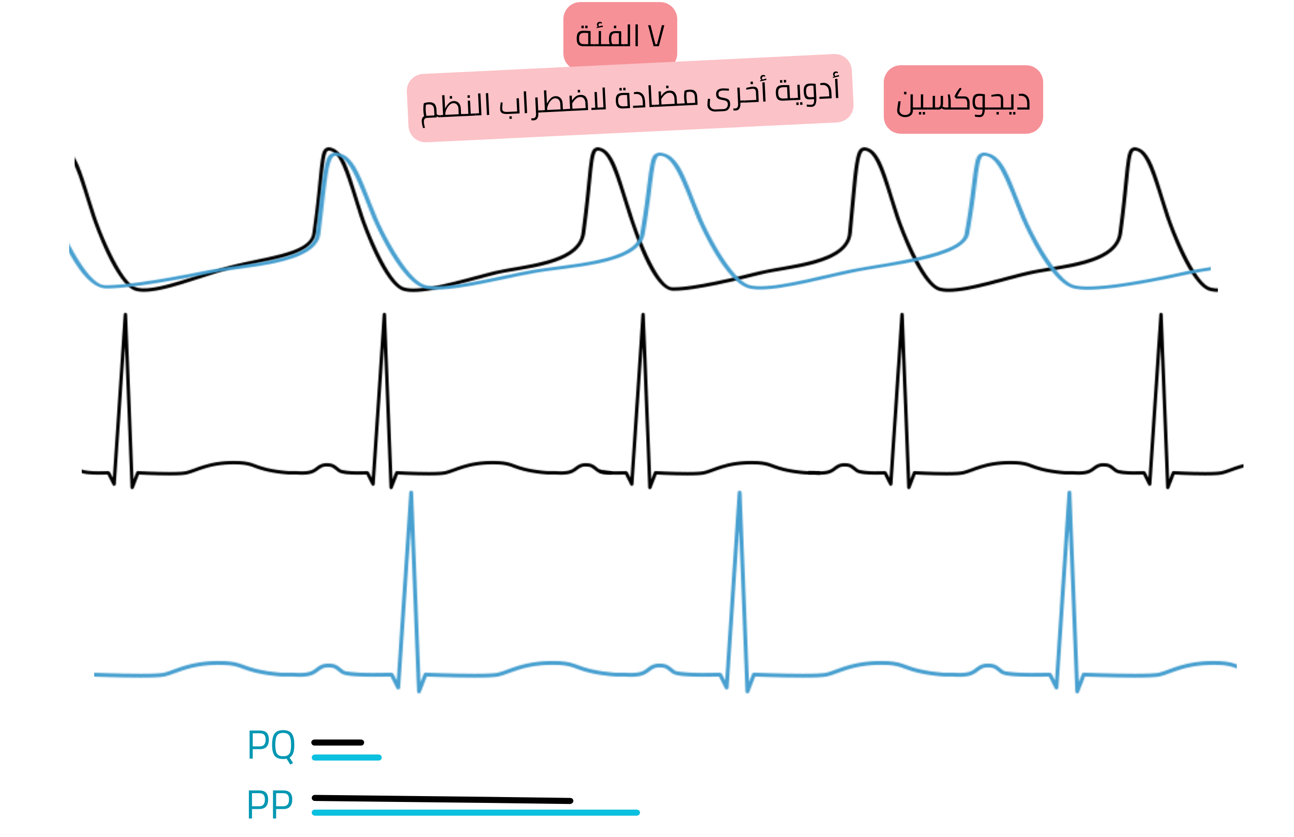 مخطط تأثير الديجوكسين كمضاد اضطراب نظم من الفئة V يوضح زيادة النشاط نظير الودي مع إطالة فترة PQ وتباطؤ معدل ضربات القلب على تخطيط القلب.