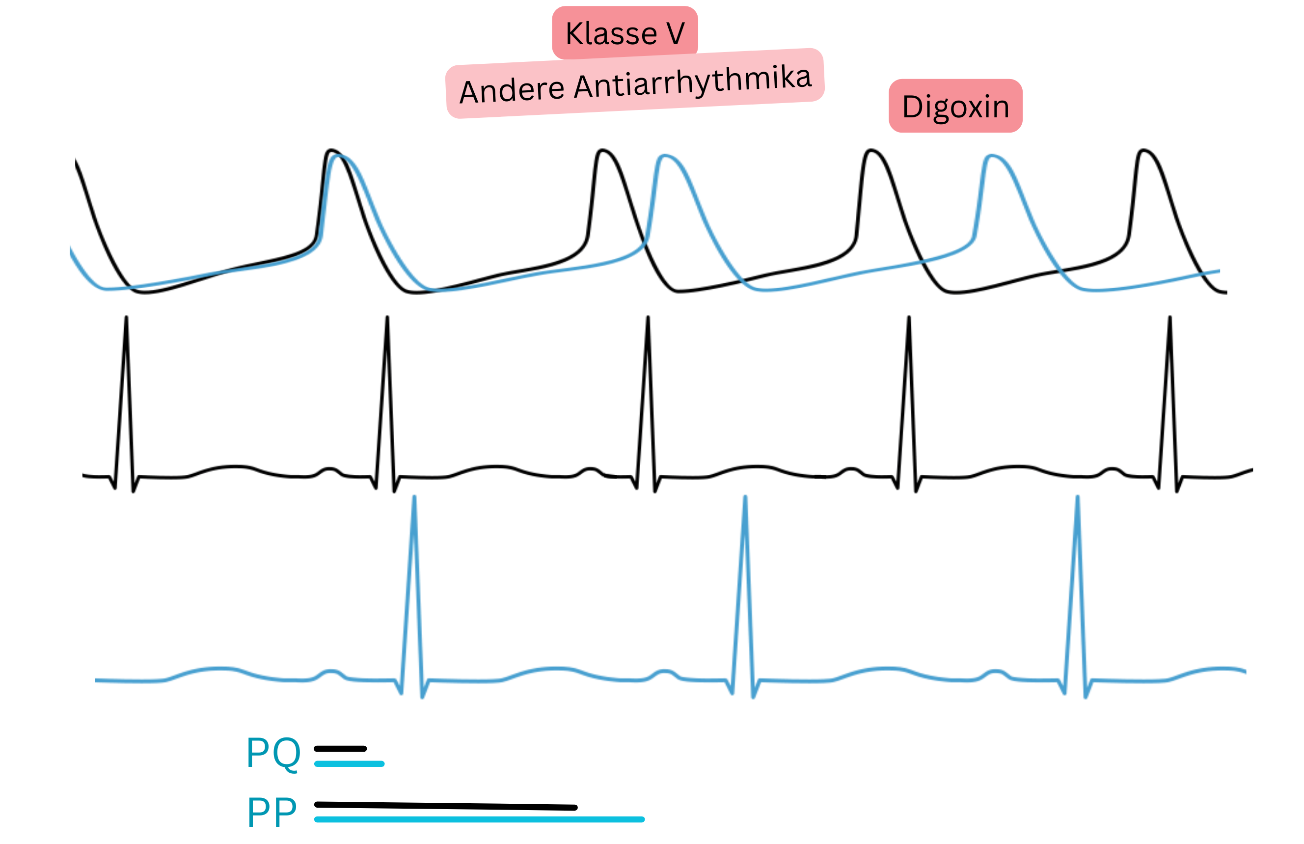 Schema der Wirkung von Digoxin als Antiarrhythmikum der Klasse V mit Darstellung einer erhöhten parasympathischen Aktivität, Verlängerung des PQ-Intervalls und Verlangsamung der Herzfrequenz im EKG.