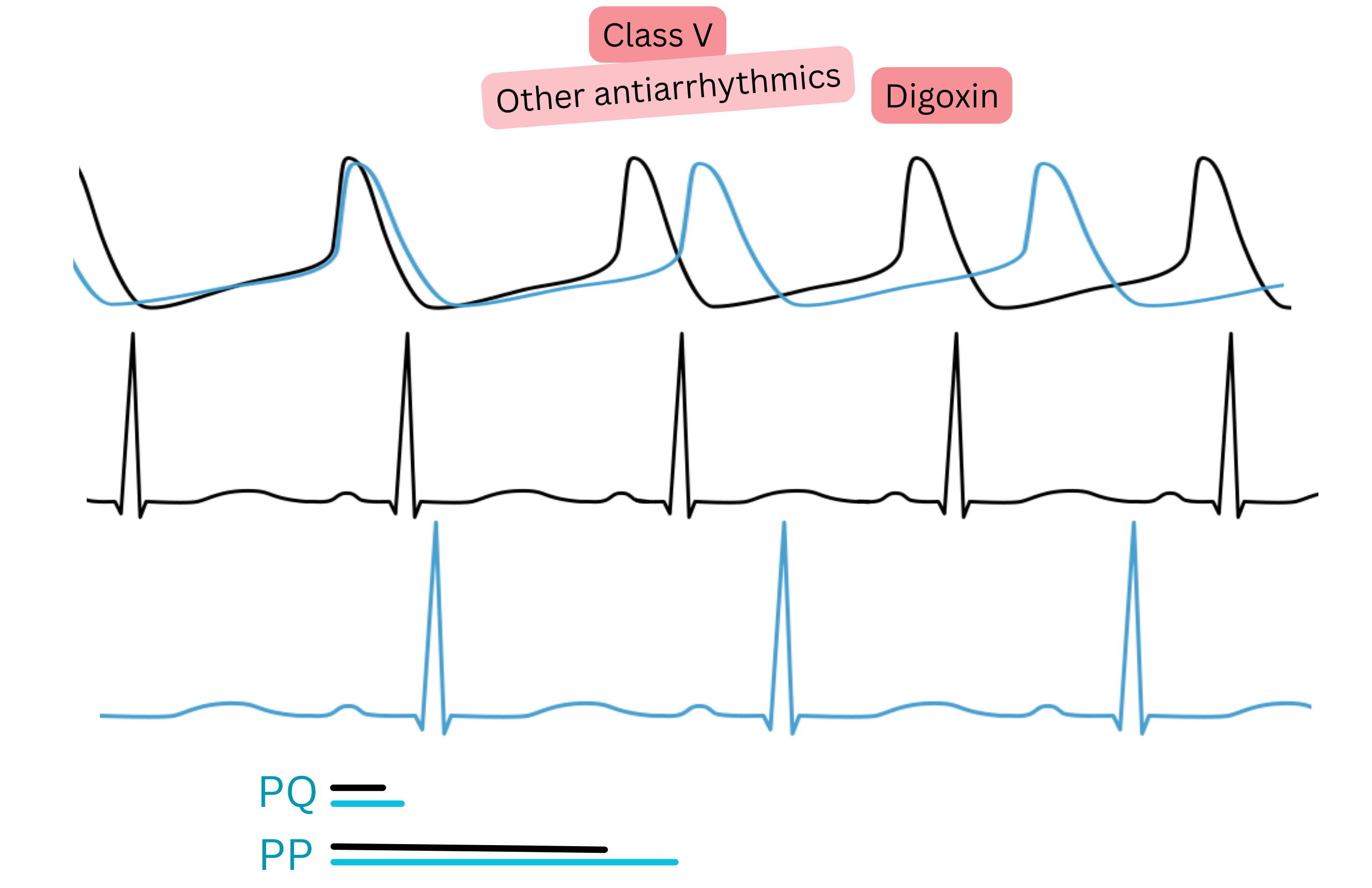 Diagram of the effect of digoxin as a class V antiarrhythmic illustrating increased parasympathetic activity with prolongation of the PQ interval and slowing of heart rate on ECG.