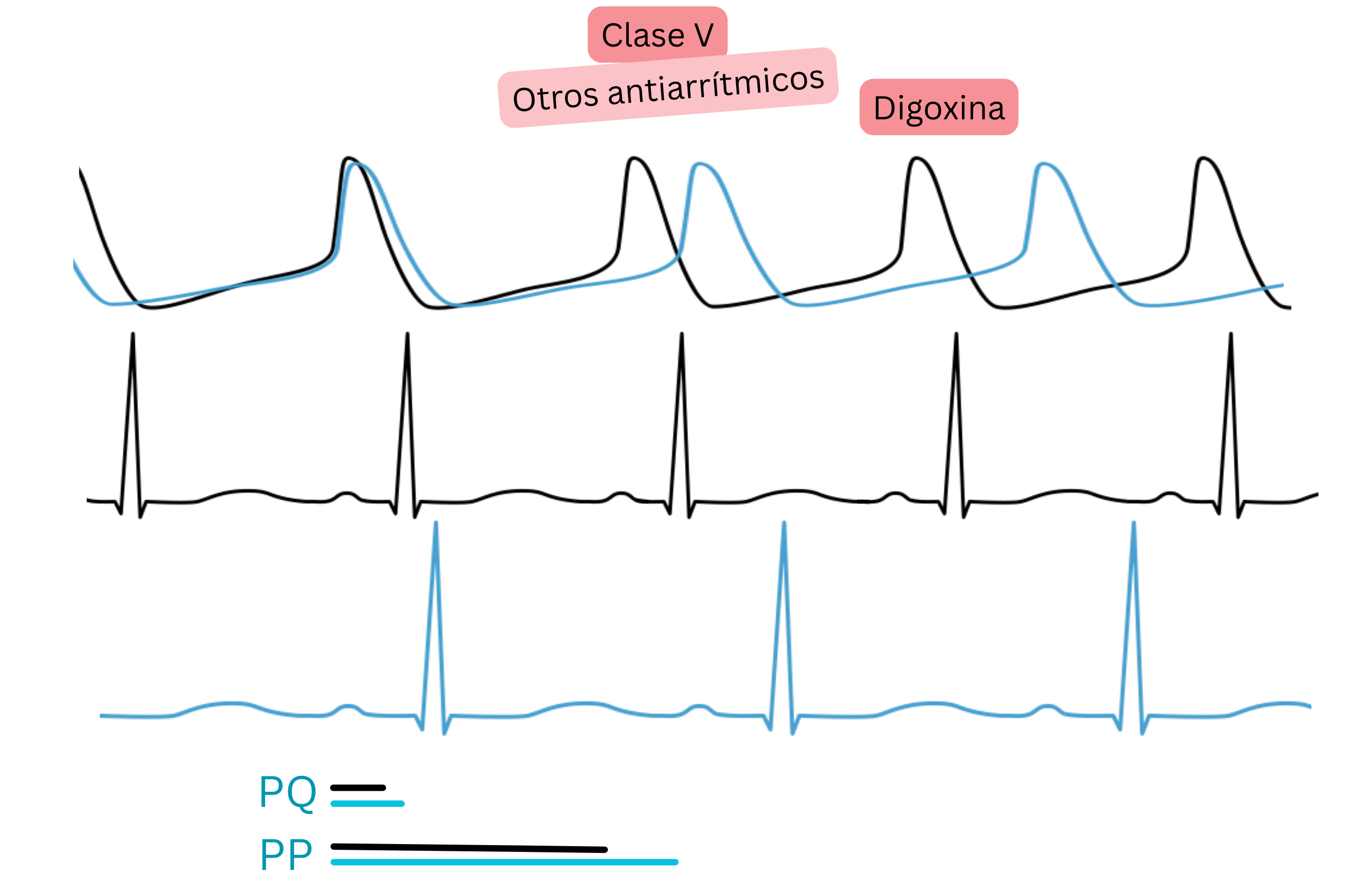 Esquema del efecto de la digoxina como antiarrítmico de clase V que muestra el aumento de la actividad parasimpática con prolongación del intervalo PQ y enlentecimiento de la frecuencia cardíaca en el ECG.
