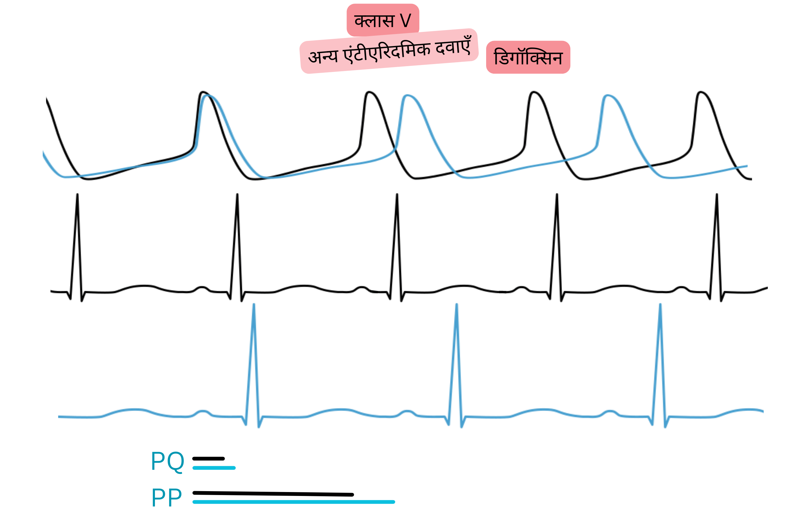 क्लास V एंटीएरिदमिक के रूप में डिगॉक्सिन के प्रभाव का आरेख, जिसमें पैरासिम्पैथेटिक गतिविधि में वृद्धि, ईसीजी पर PQ अंतराल का बढ़ना और हृदय गति का धीमा होना दर्शाया गया है।