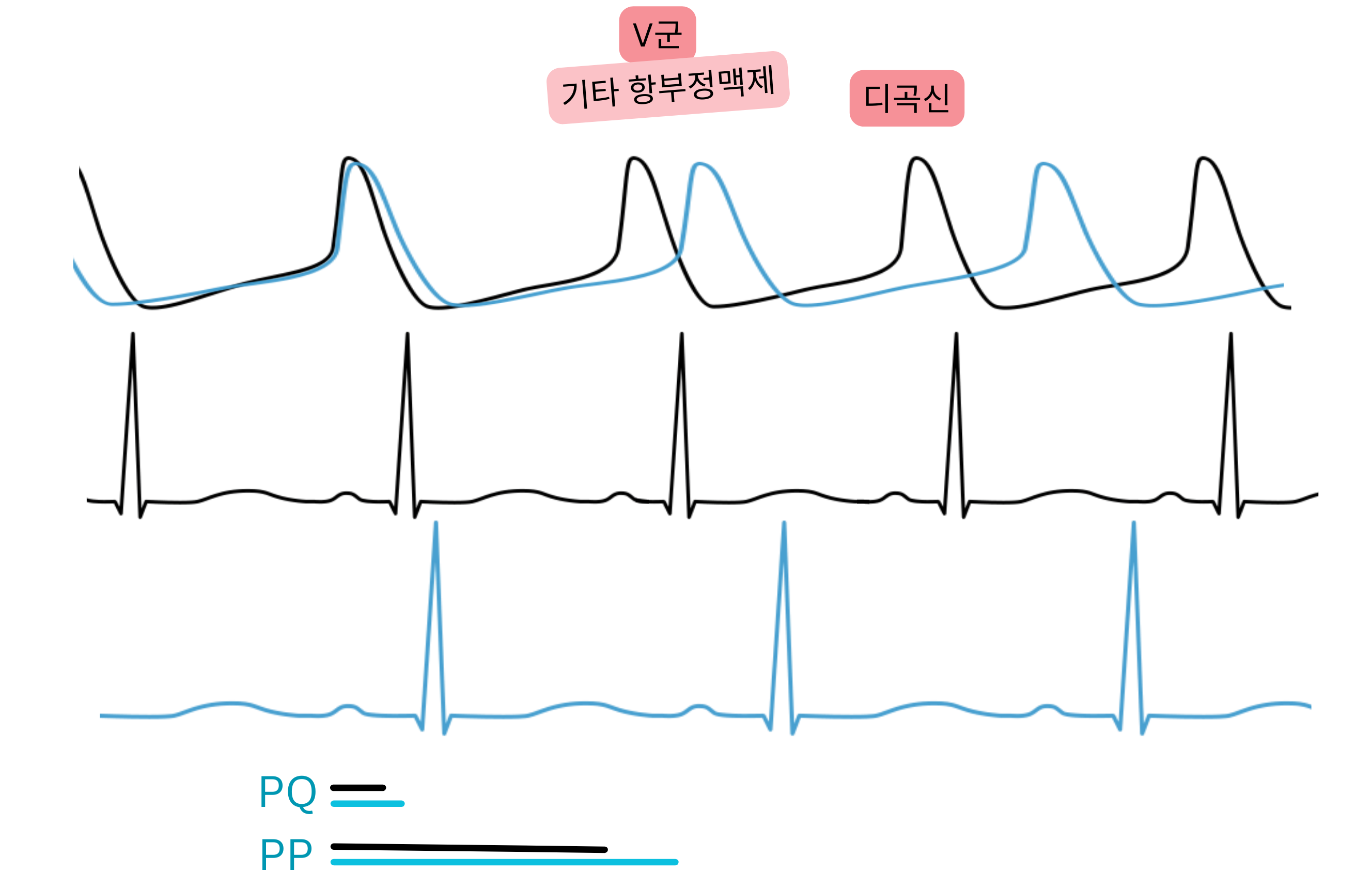 V군 항부정맥제로서 디곡신의 효과를 나타낸 도식으로, 부교감신경 활성 증가로 PQ 간격이 연장되고 심박수가 감소함을 보여준다.