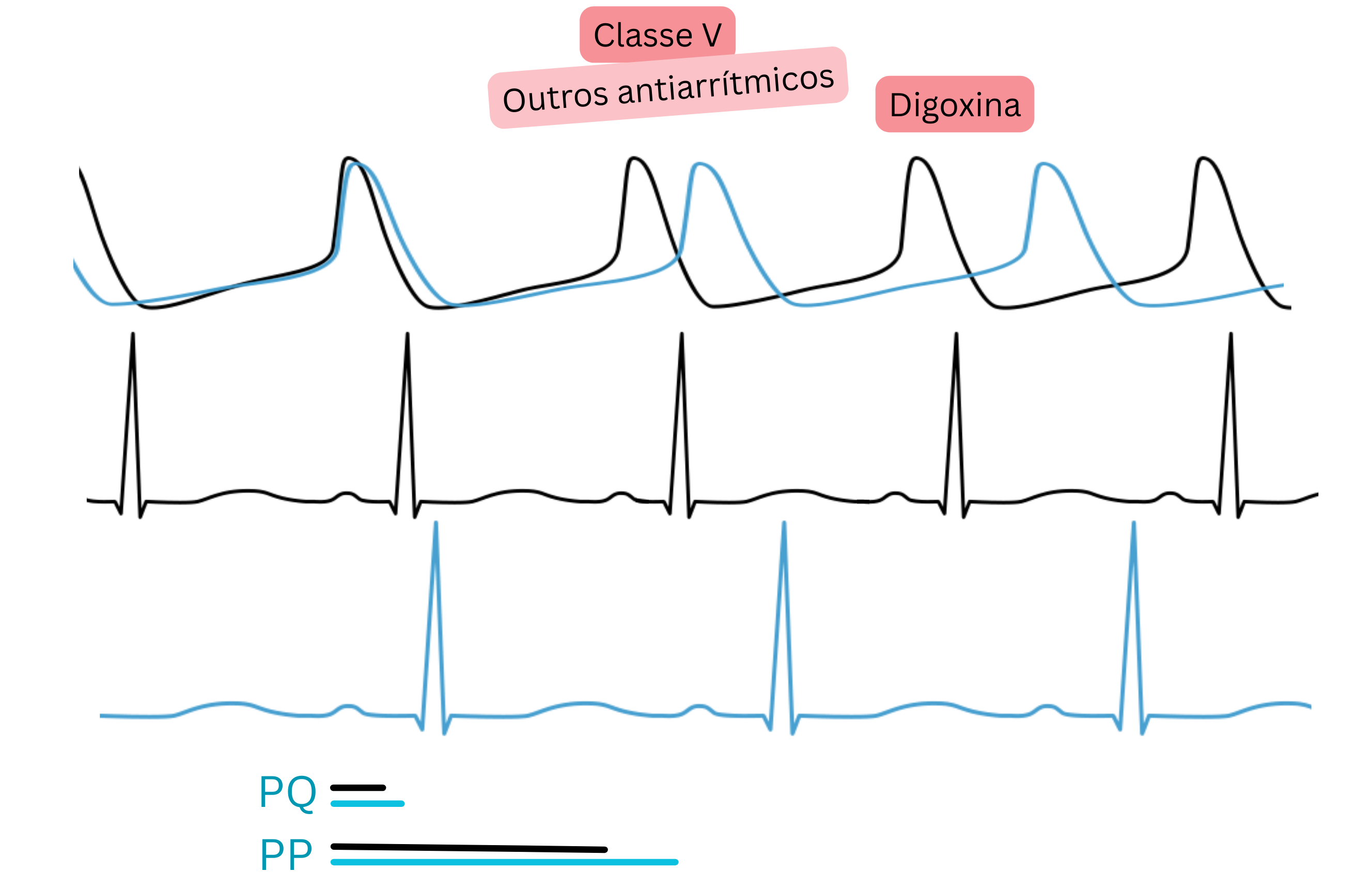Esquema do efeito da digoxina como antiarrítmico de classe V demonstrando aumento da atividade parassimpática com prolongamento do intervalo PQ e redução da frequência cardíaca no ECG.