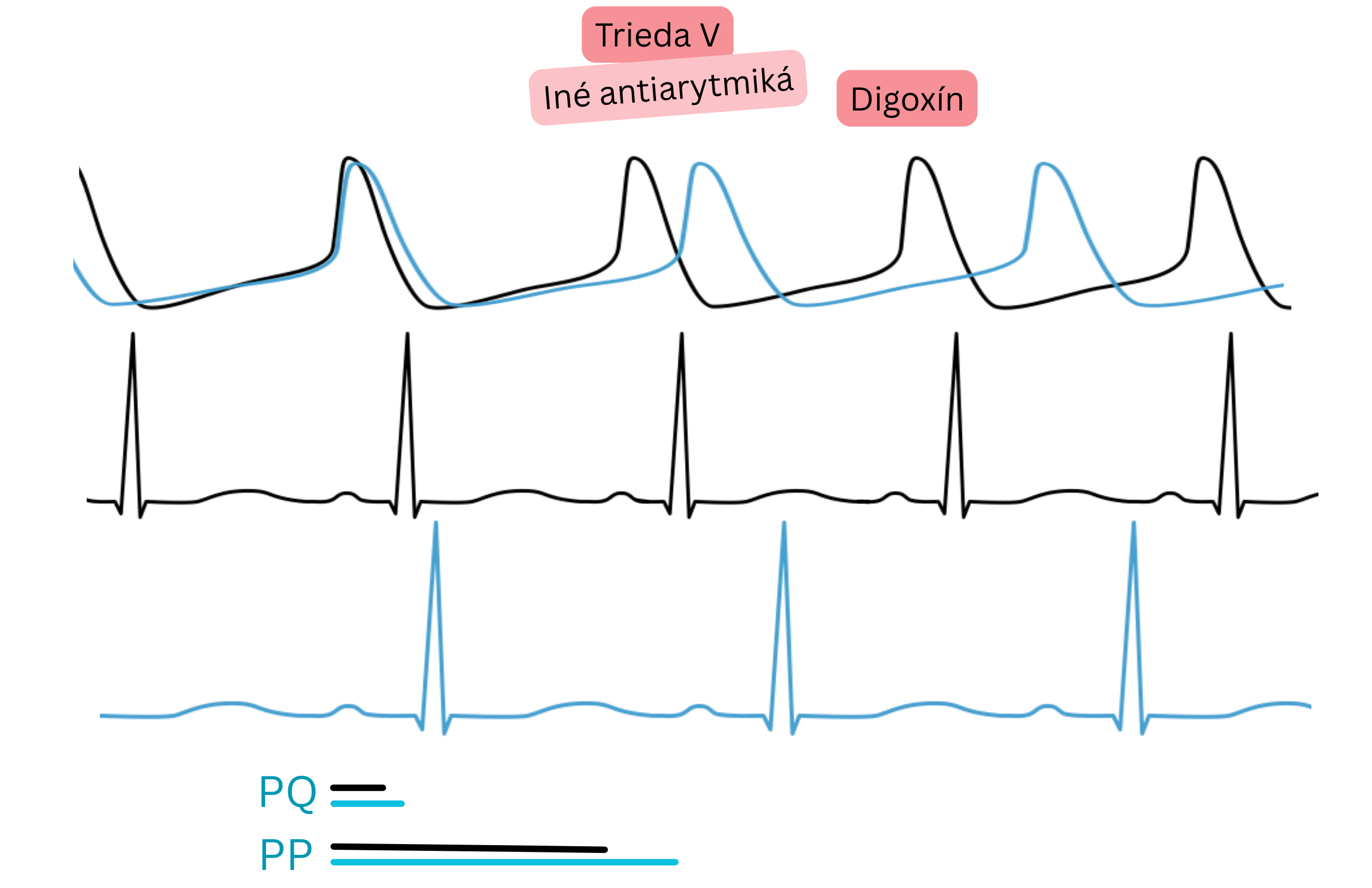 Schéma účinku digoxínu ako antiarytmika triedy V znázorňujúca zvýšenie parasympatickej aktivity s predĺžením PQ intervalu a spomalením srdcovej frekvencie na EKG.
