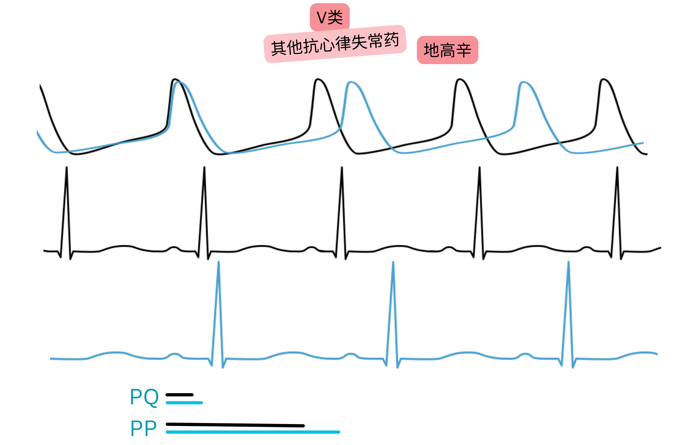 地高辛作为V类抗心律失常药物的作用示意图，显示副交感神经活性增强，导致心电图PQ间期延长和心率减慢。