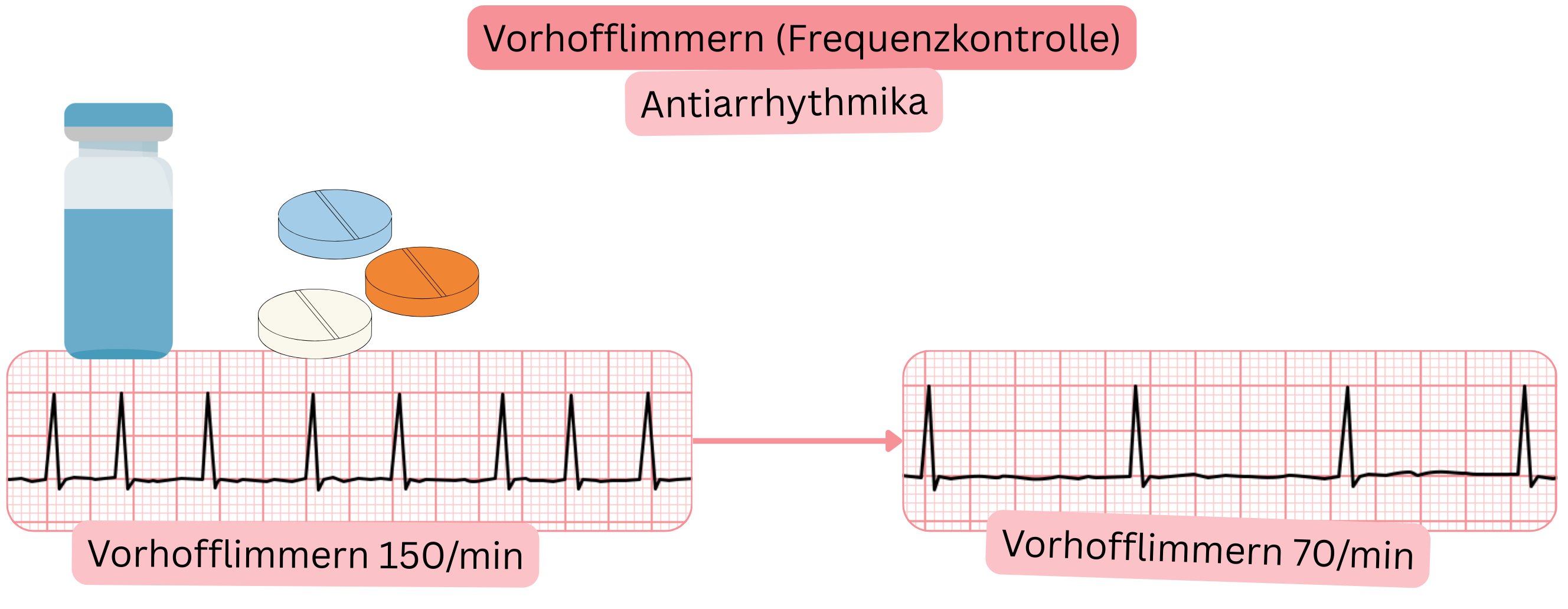 Schema der Frequenzkontrolle bei Vorhofflimmern mit medikamentöser Therapie, das eine Reduktion der ventrikulären Frequenz von 150/min auf 70/min zeigt.