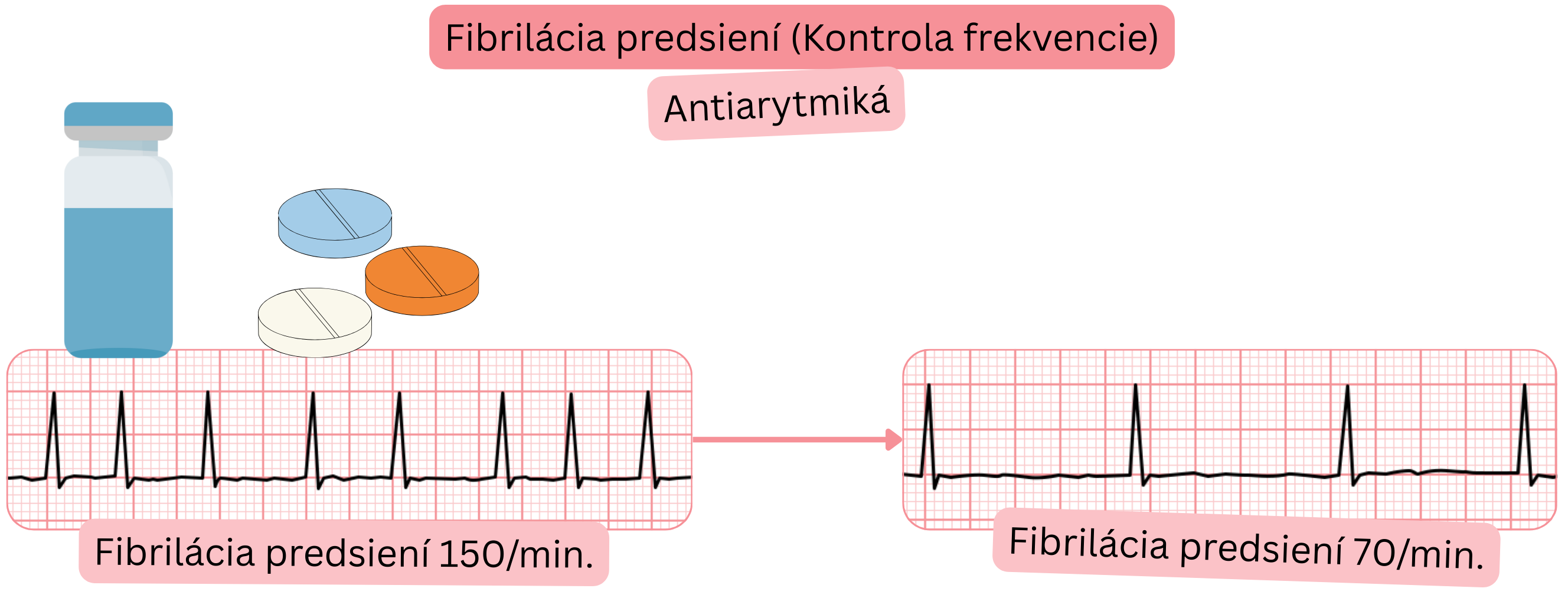 Schéma kontroly frekvencie pri fibrilácii predsiení s farmakologickou liečbou znázorňujúca zníženie komorovej frekvencie zo 150/min na 70/min.