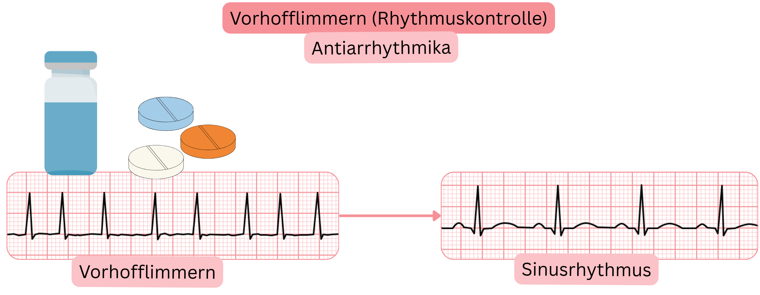 Schema der Rhythmuskontrolle bei Vorhofflimmern mit antiarrhythmischer Therapie, das die Wiederherstellung und Aufrechterhaltung des Sinusrhythmus zeigt.