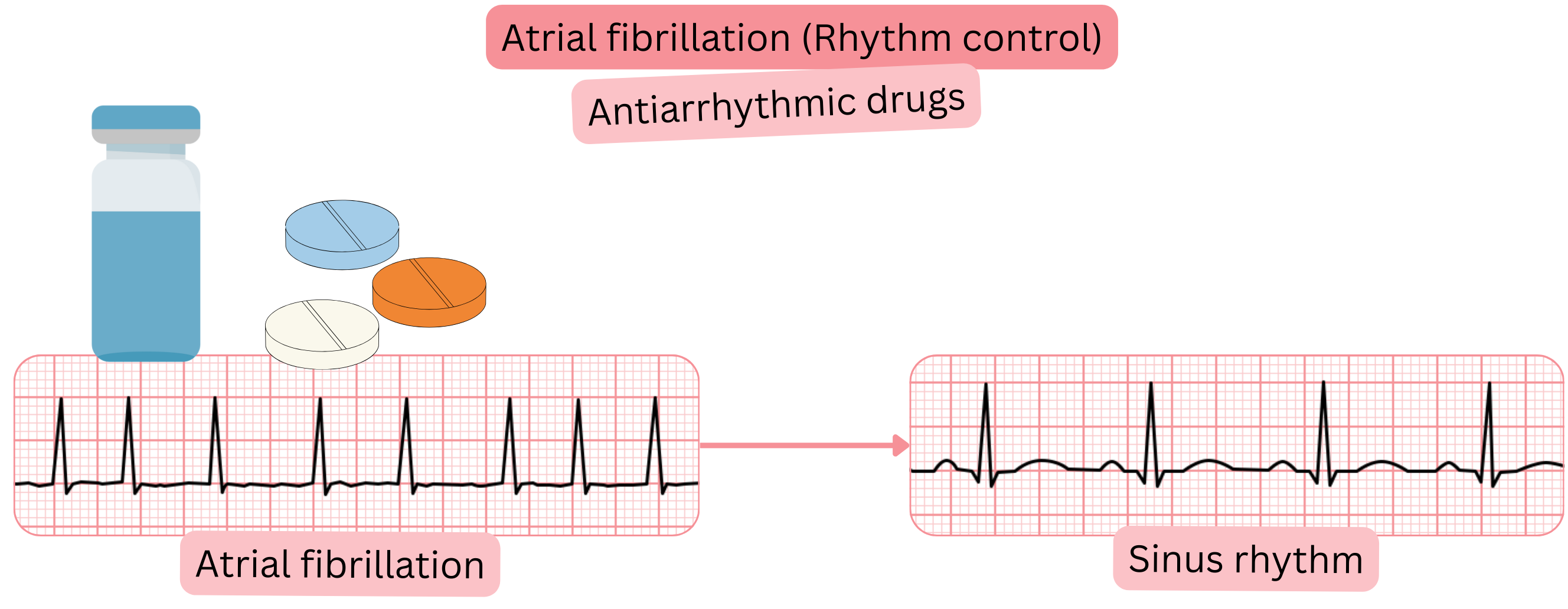 Rhythm control scheme in atrial fibrillation using antiarrhythmic therapy illustrating restoration and maintenance of sinus rhythm.