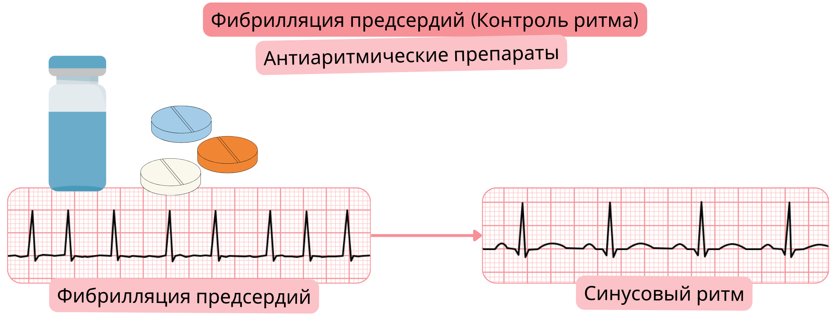 Схема контроля ритма при фибрилляции предсердий с антиаритмической терапией, демонстрирующая восстановление и поддержание синусового ритма.