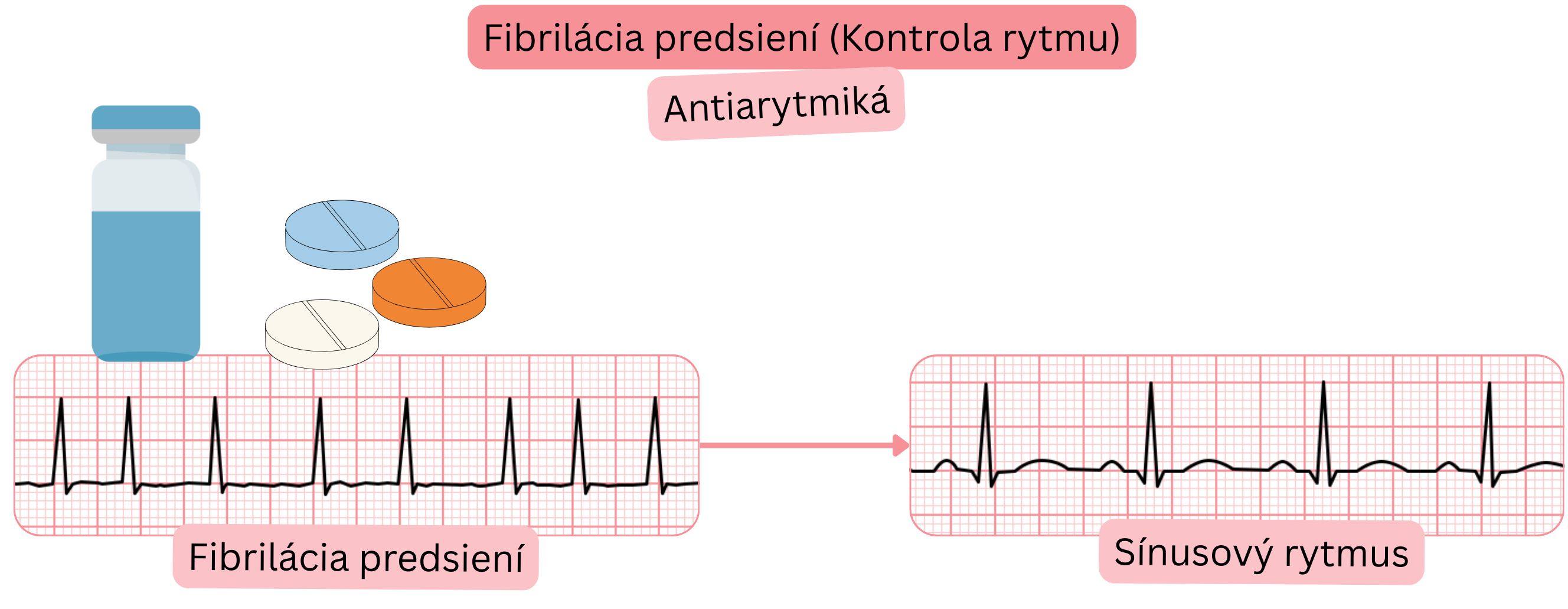 Schéma kontroly rytmu pri fibrilácii predsiení s antiarytmickou liečbou znázorňujúca obnovenie a udržanie sínusového rytmu.