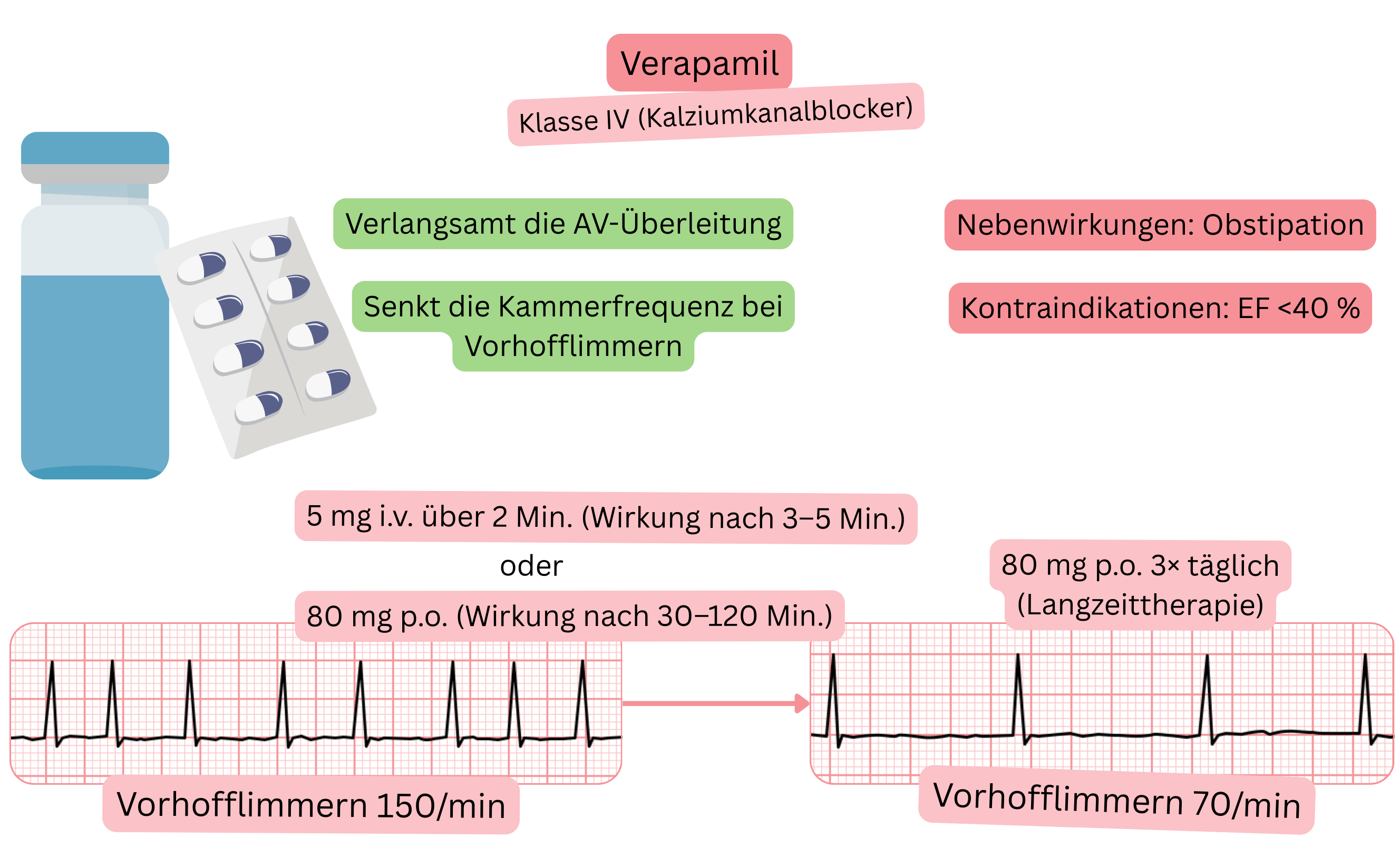 Schema der Wirkung von Verapamil als Antiarrhythmikum der Klasse IV mit Darstellung der Verlangsamung der Überleitung über den atrioventrikulären Knoten und der Reduktion der ventrikulären Antwort bei Vorhofflimmern.