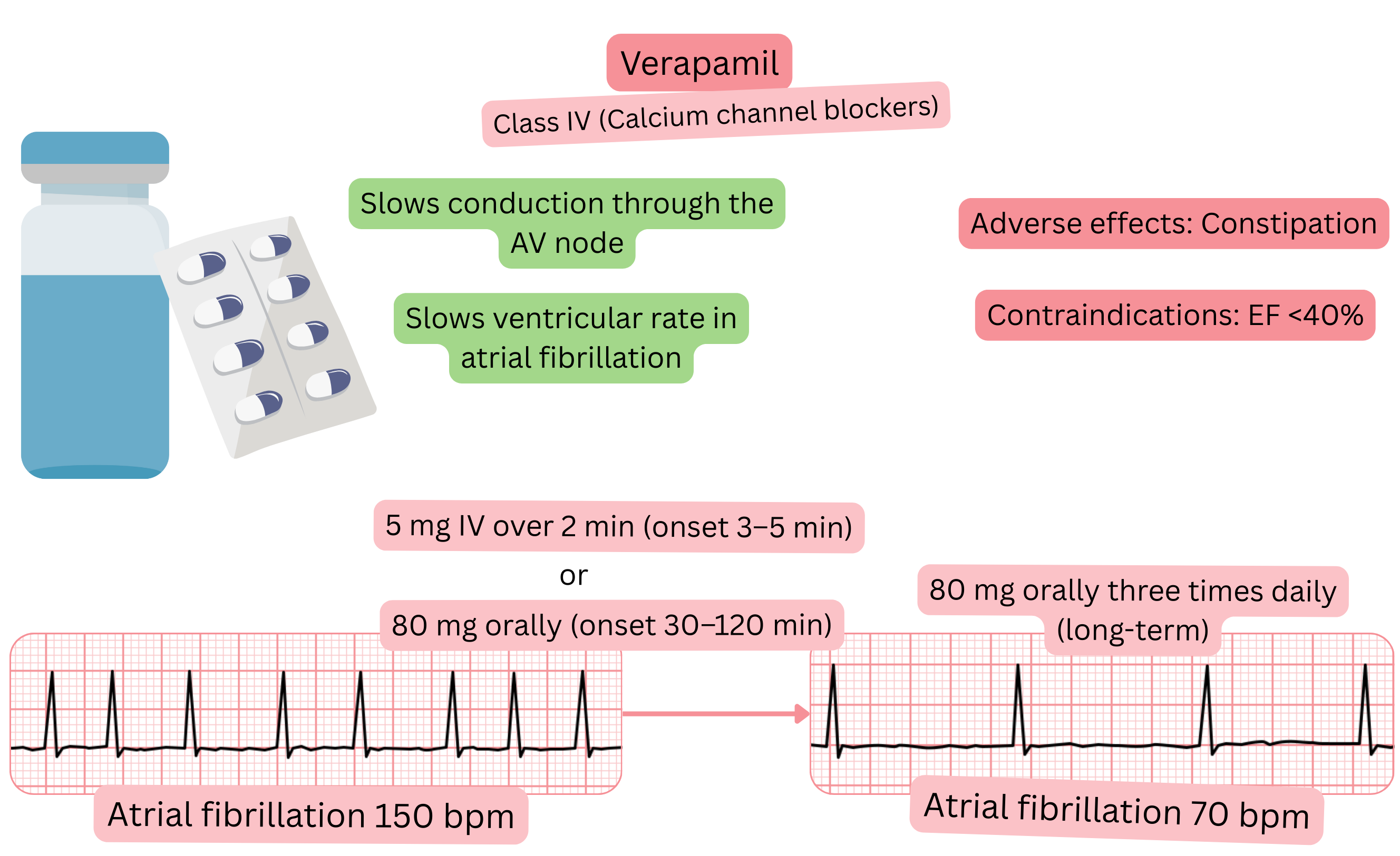 Diagram of the effect of verapamil as a class IV antiarrhythmic illustrating slowed conduction through the atrioventricular node and reduced ventricular response during atrial fibrillation.