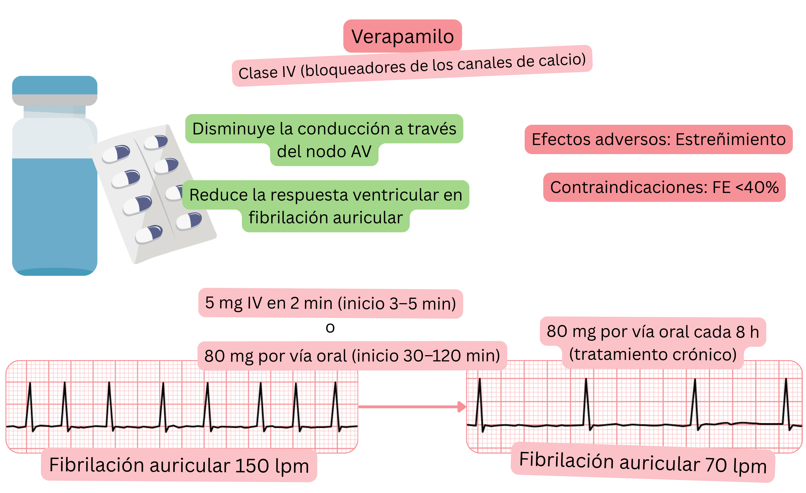 Esquema del efecto del verapamilo como antiarrítmico de clase IV que muestra el enlentecimiento de la conducción a través del nodo auriculoventricular y la reducción de la respuesta ventricular en la fibrilación auricular.