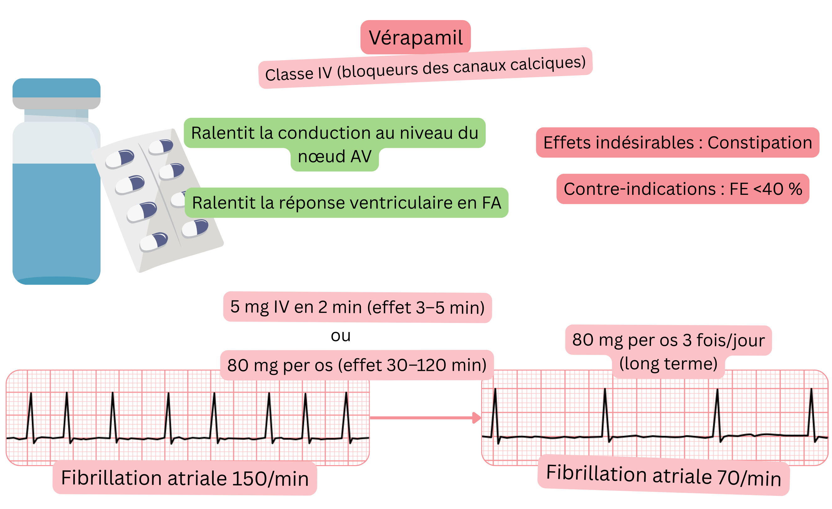 Schéma de l’effet du vérapamil comme antiarythmique de classe IV illustrant le ralentissement de la conduction à travers le nœud auriculoventriculaire et la réduction de la réponse ventriculaire lors de la fibrillation auriculaire.