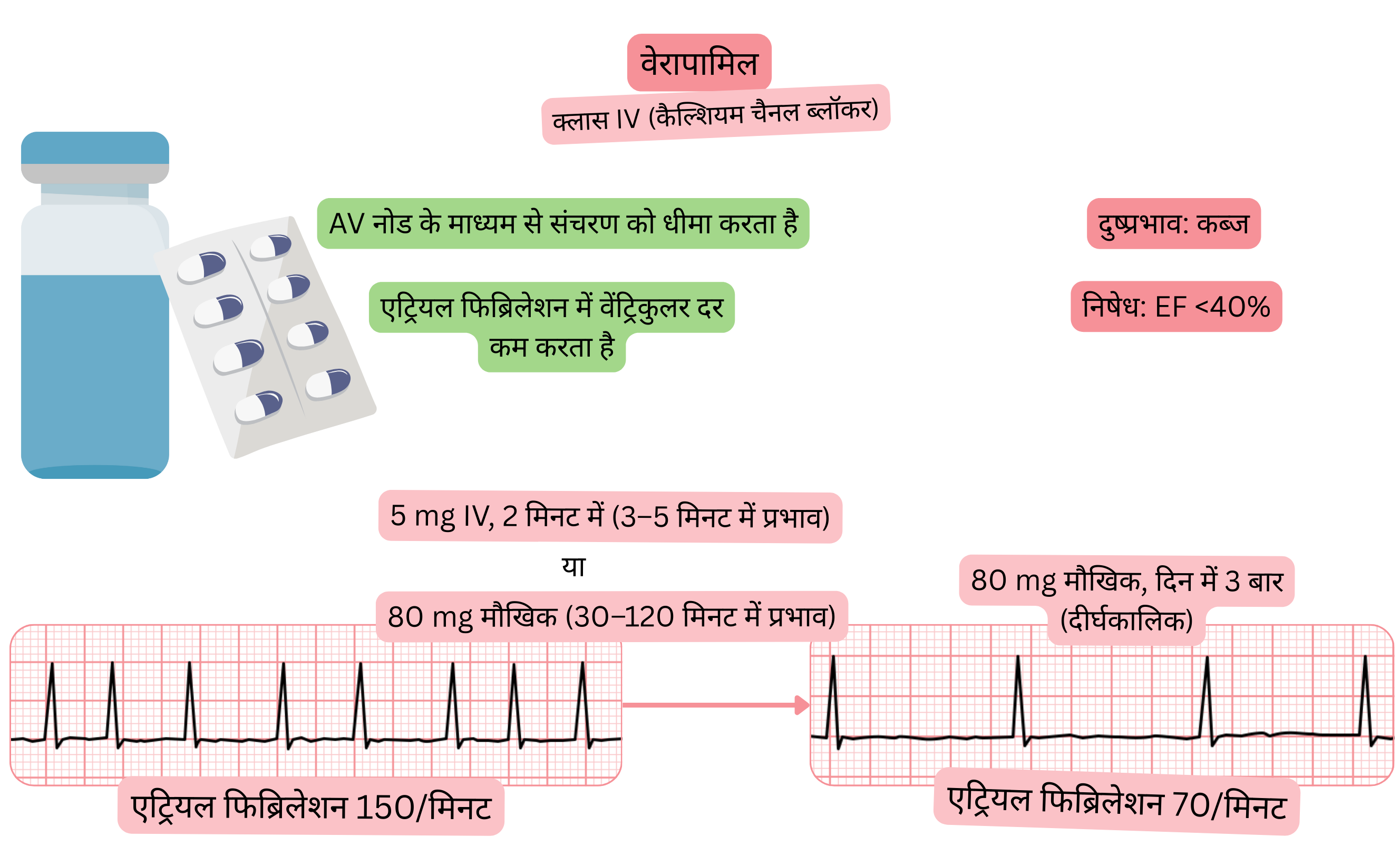 क्लास IV एंटीएरिदमिक के रूप में वेरापामिल के प्रभाव का आरेख, जिसमें एट्रियोवेंट्रिकुलर नोड के माध्यम से संचरण के धीमे होने और एट्रियल फिब्रिलेशन में वेंट्रिकुलर प्रतिक्रिया में कमी को दर्शाया गया है।