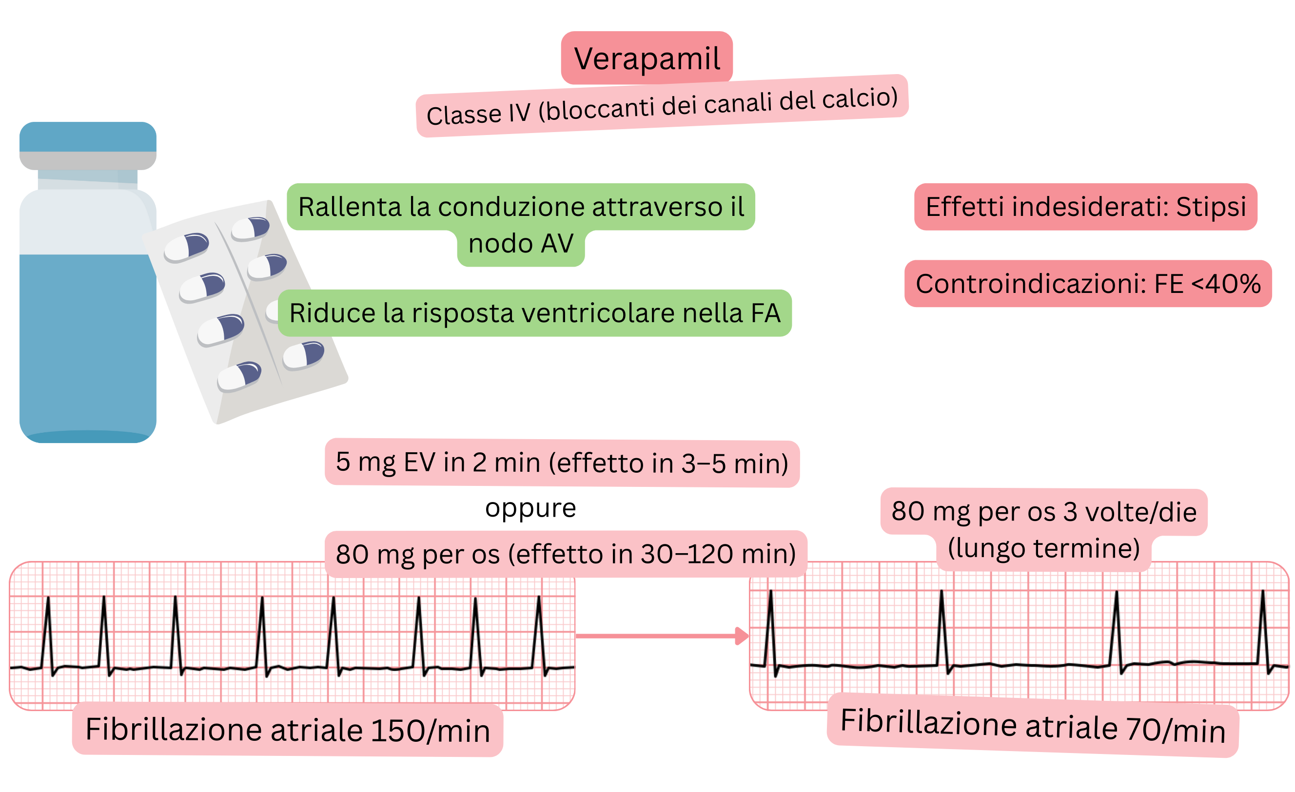 Schema dell’effetto del verapamil come antiaritmico di classe IV che illustra il rallentamento della conduzione attraverso il nodo atrioventricolare e la riduzione della risposta ventricolare nella fibrillazione atriale.
