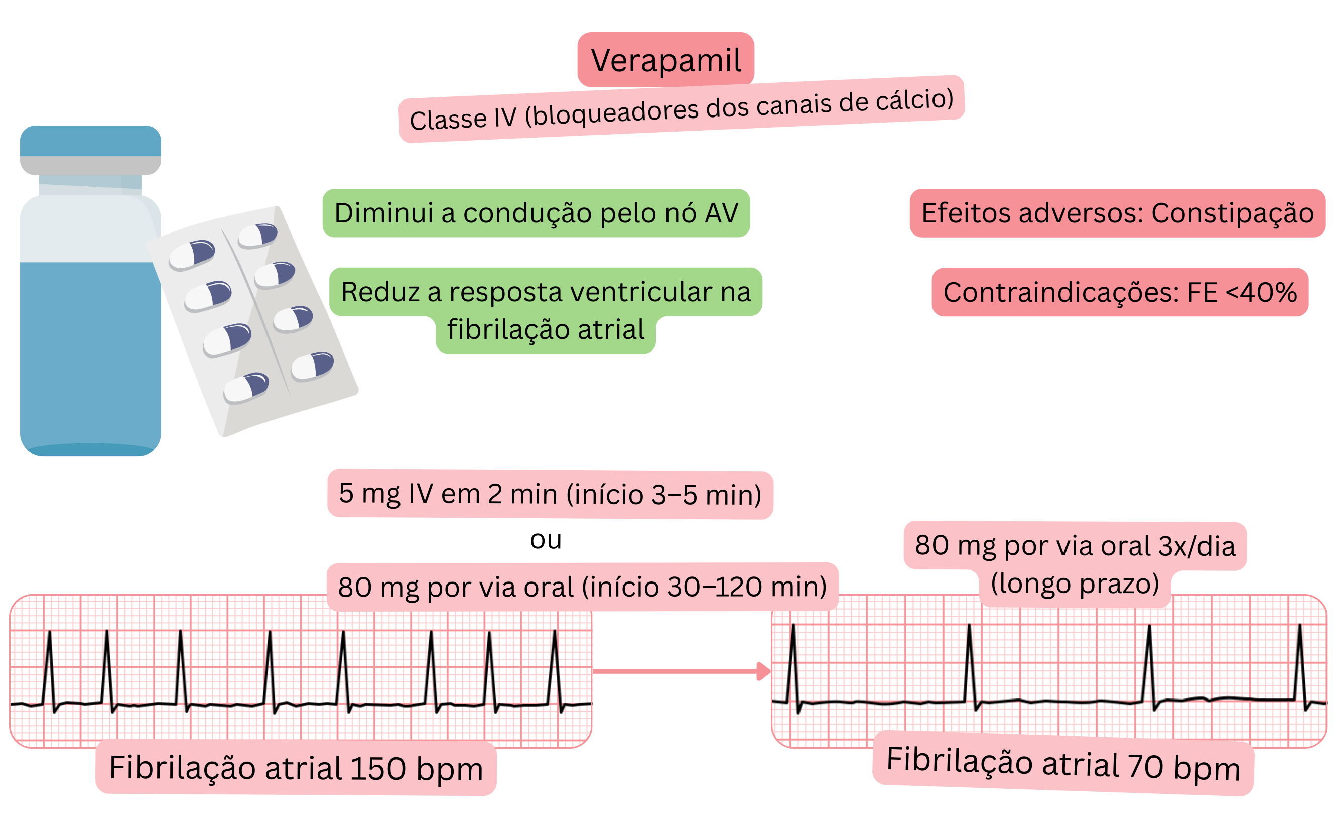 Esquema do efeito do verapamil como antiarrítmico de classe IV demonstrando lentificação da condução pelo nó atrioventricular e redução da resposta ventricular na fibrilação atrial.