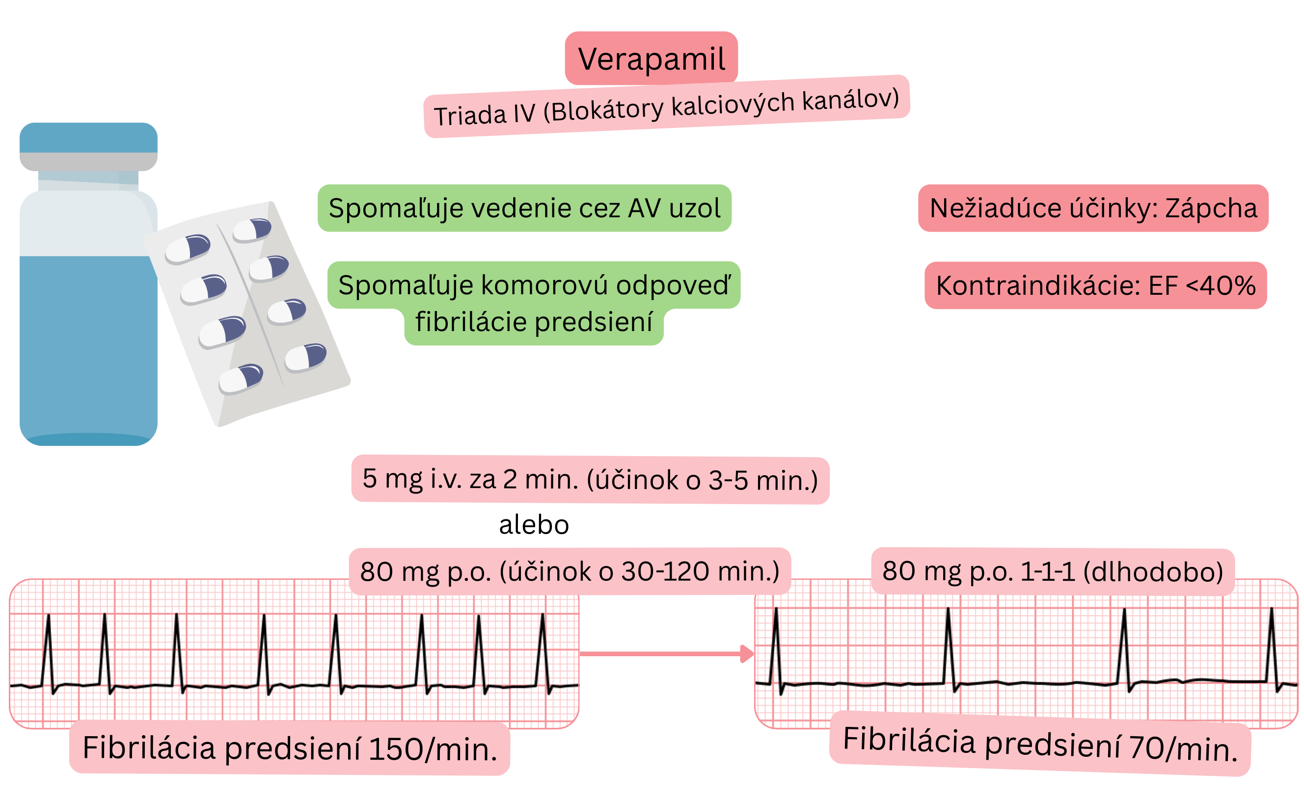 Schéma účinku verapamilu ako antiarytmika triedy IV znázorňujúca spomalenie vedenia cez atrioventrikulárny uzol a zníženie komorovej odpovede pri fibrilácii predsiení.