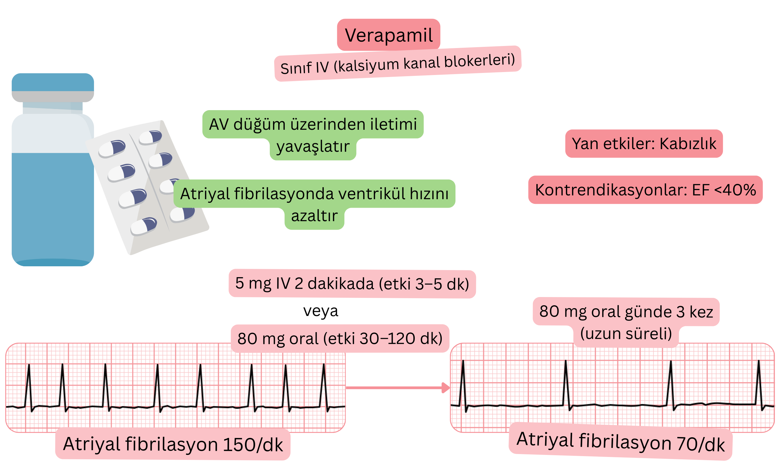 IV sınıfı antiaritmik olarak verapamilin etkisini gösteren şema; atriyoventriküler düğümden iletimin yavaşlamasını ve atriyal fibrilasyonda ventriküler yanıtın azalmasını göstermektedir.