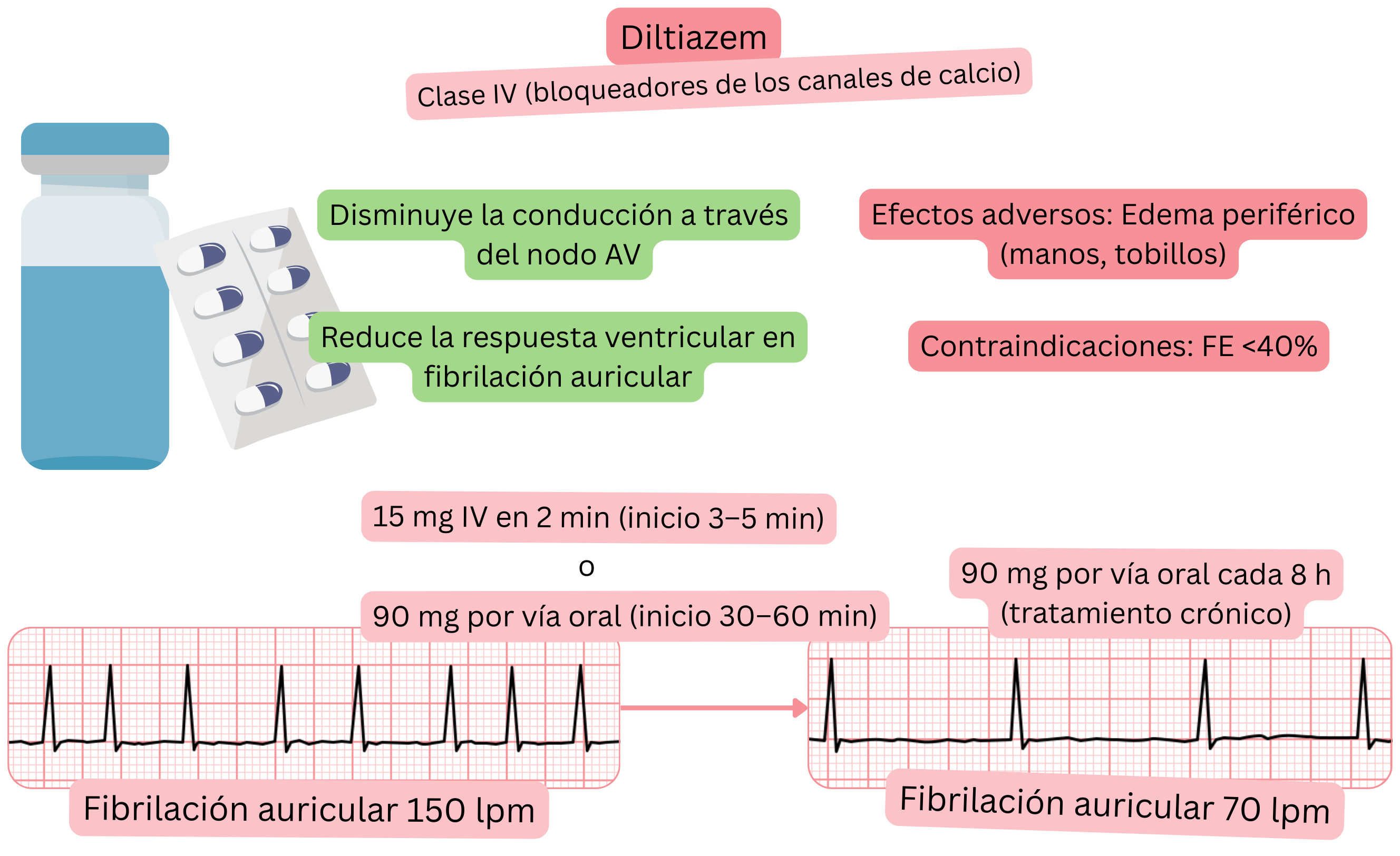 Esquema del efecto del diltiazem como antiarrítmico de clase IV que muestra el enlentecimiento de la conducción a través del nodo auriculoventricular y la reducción de la frecuencia ventricular en la fibrilación auricular.